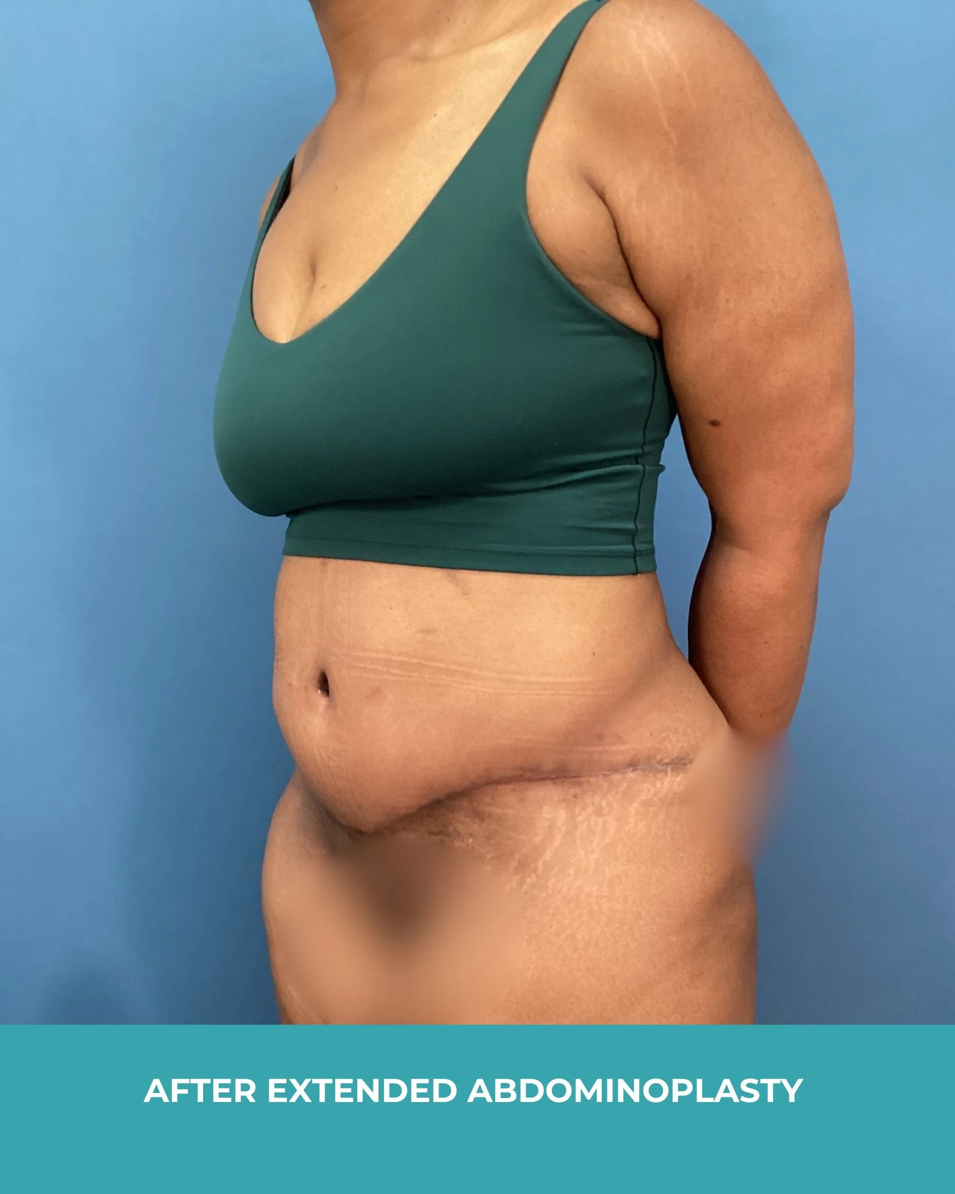 B&A extended abdominoplasty2 (4).jpg