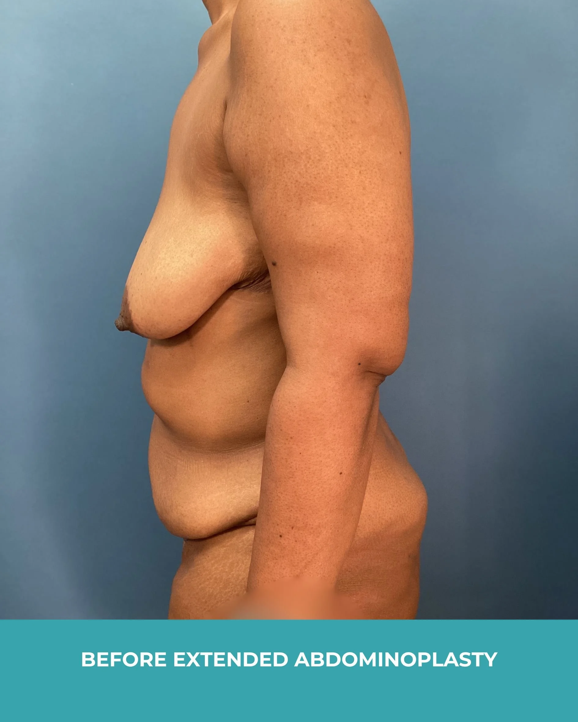 B&A extended abdominoplasty2 (5).jpg