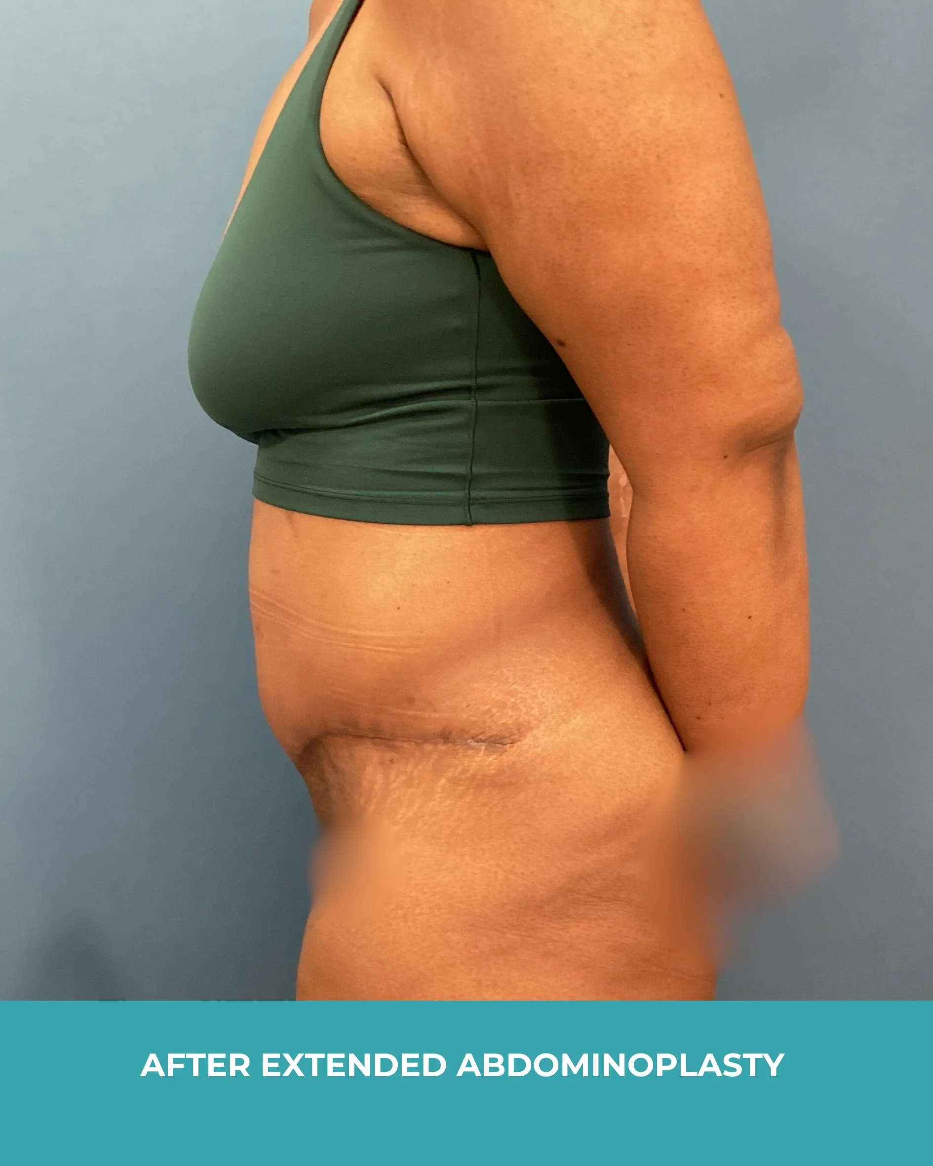 B&A extended abdominoplasty2 (6).jpg