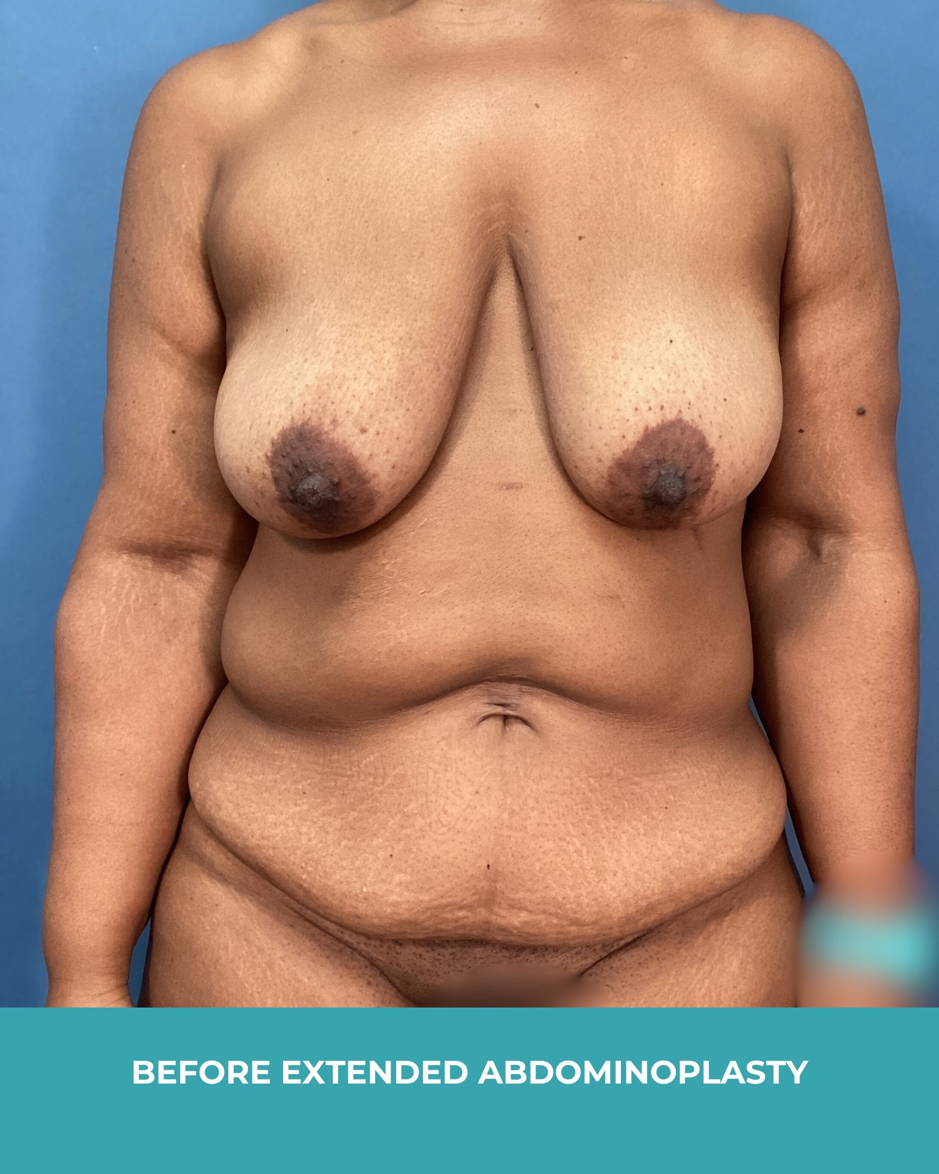B&A extended abdominoplasty2.jpg