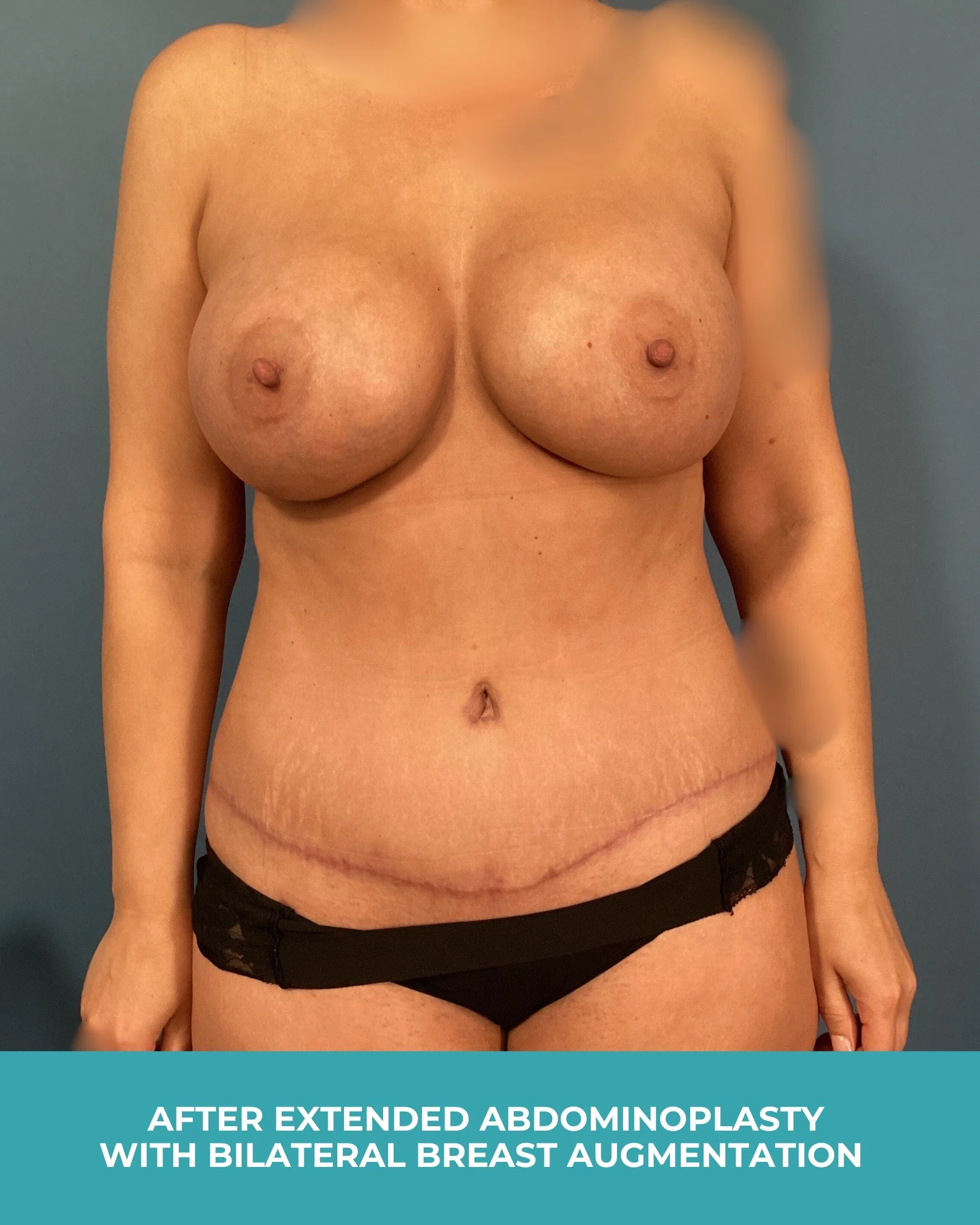 B&A extended abdominoplasty with bilateral breast augmentation (2).jpg