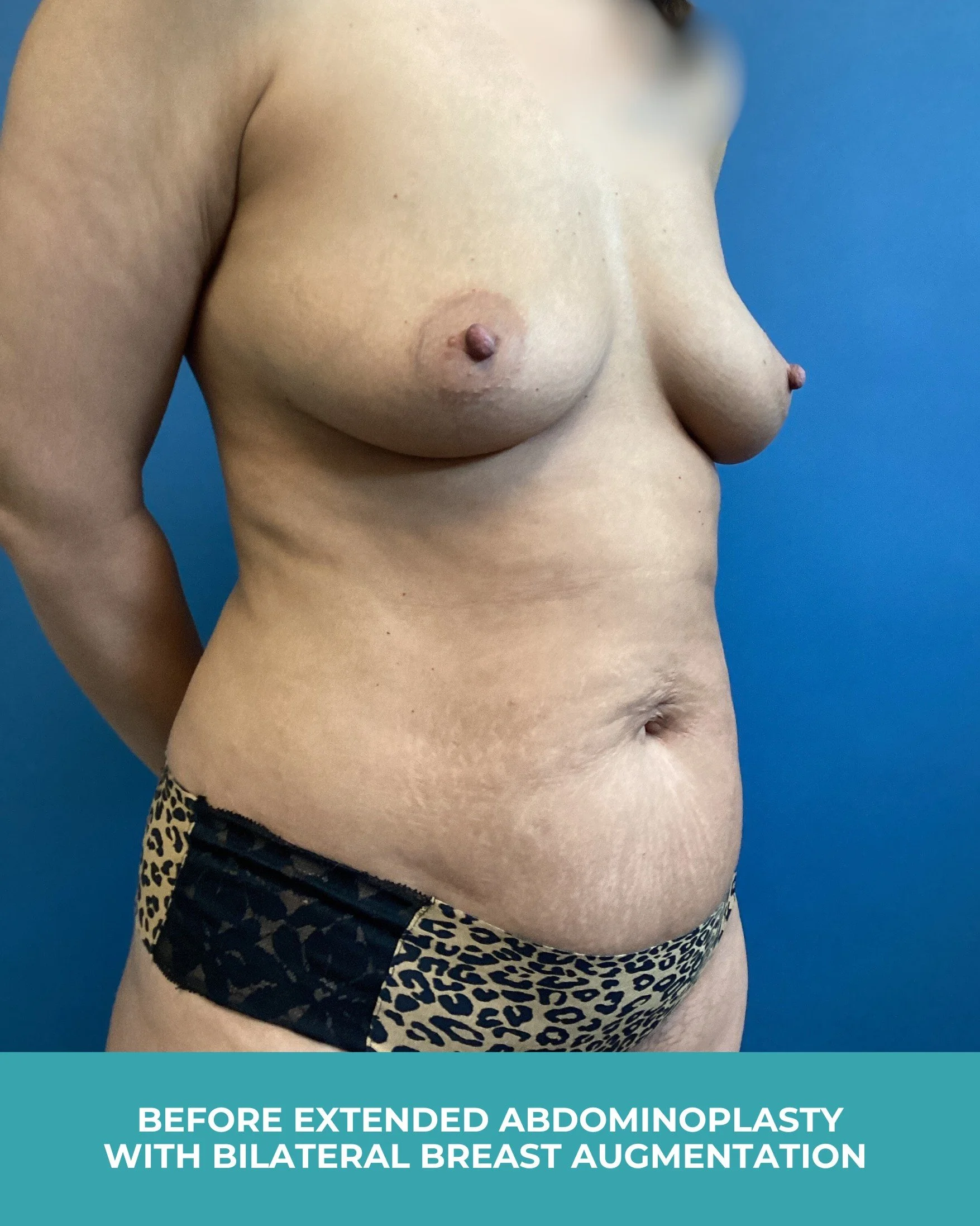 B&A extended abdominoplasty with bilateral breast augmentation (3).jpg