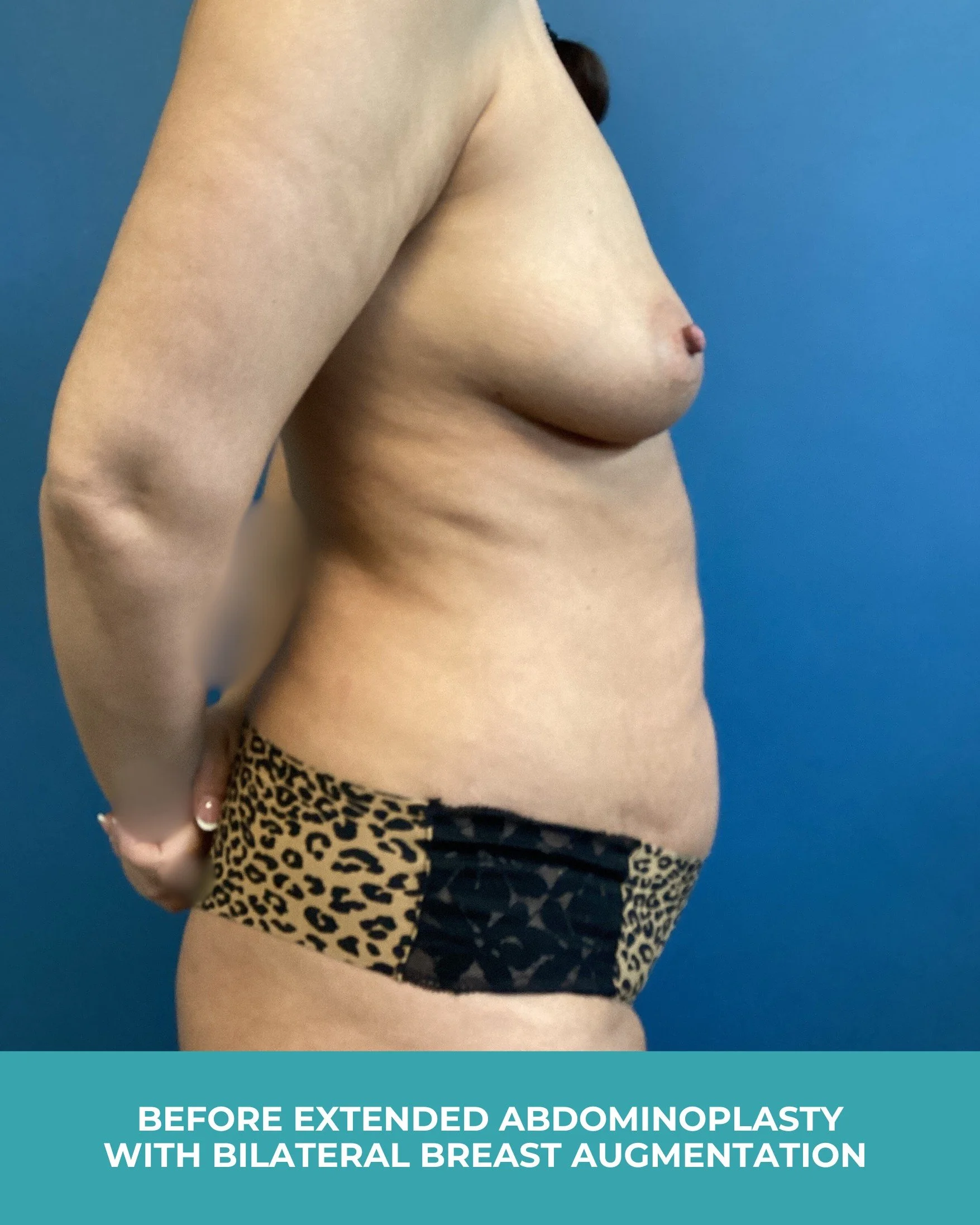 B&A extended abdominoplasty with bilateral breast augmentation (5).jpg