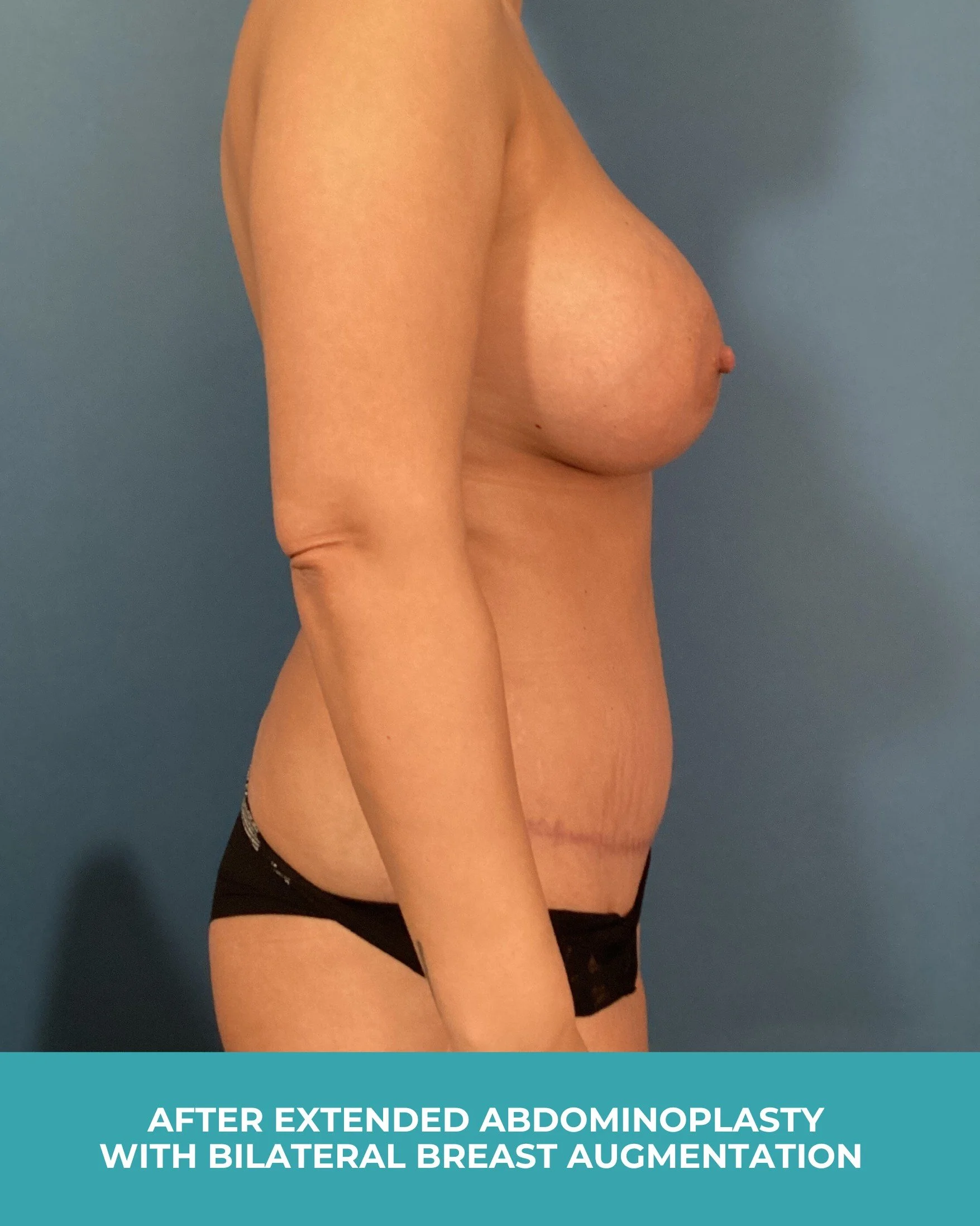 B&A extended abdominoplasty with bilateral breast augmentation (6).jpg