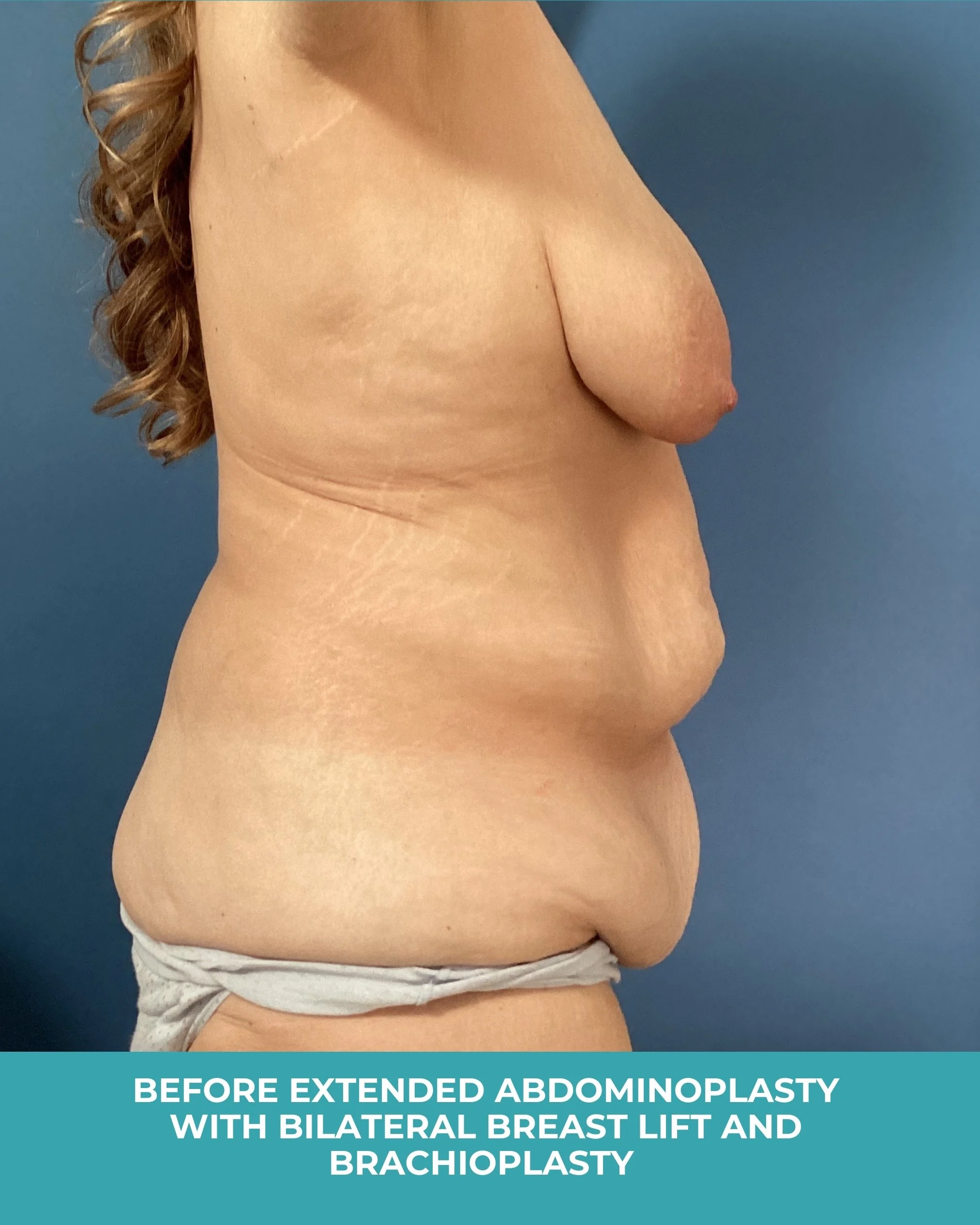B&A extended abdominoplasty with bilateral breast lift and brachioplasty (5).jpg