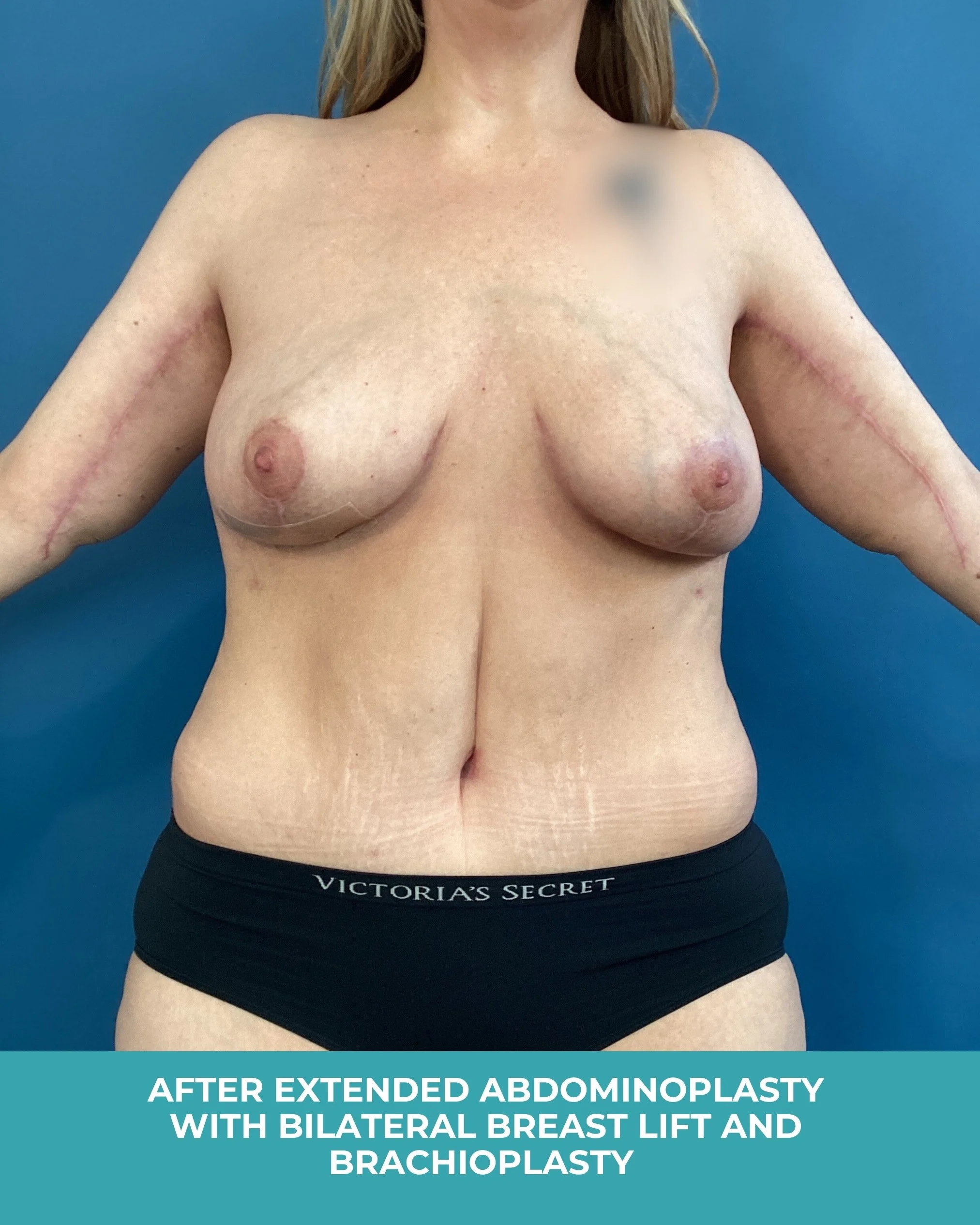 B&A extended abdominoplasty with bilateral breast lift and brachioplasty (2).jpg