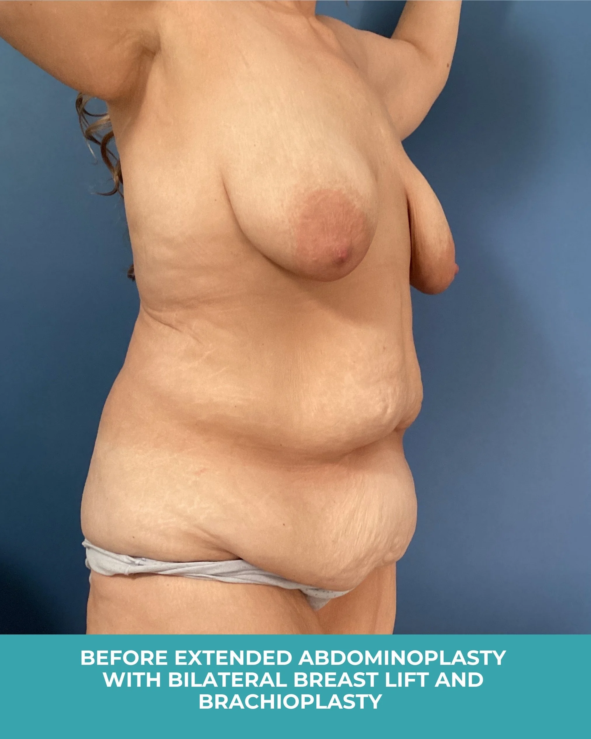 B&A extended abdominoplasty with bilateral breast lift and brachioplasty (3).jpg