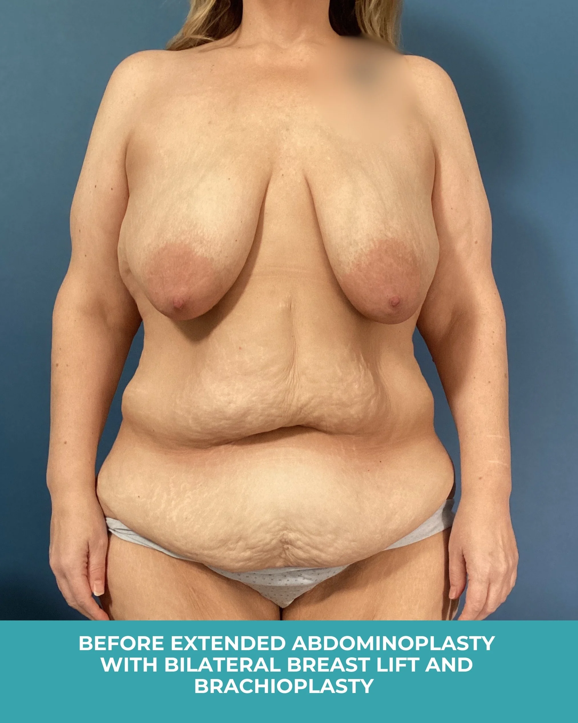 B&A extended abdominoplasty with bilateral breast lift and brachioplasty.jpg