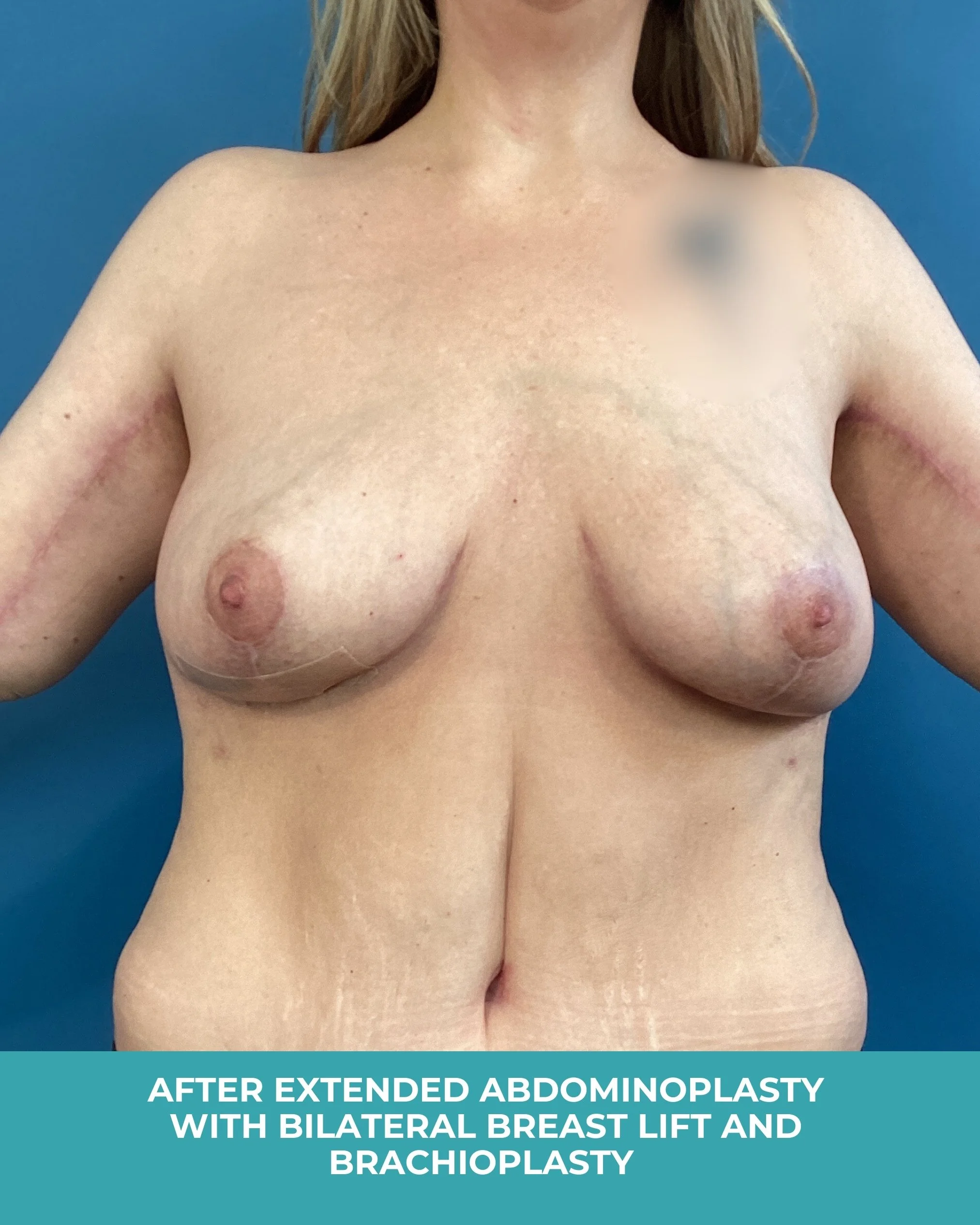 B&A extended abdominoplasty with bilateral breast lift and brachioplastyB (2).jpg