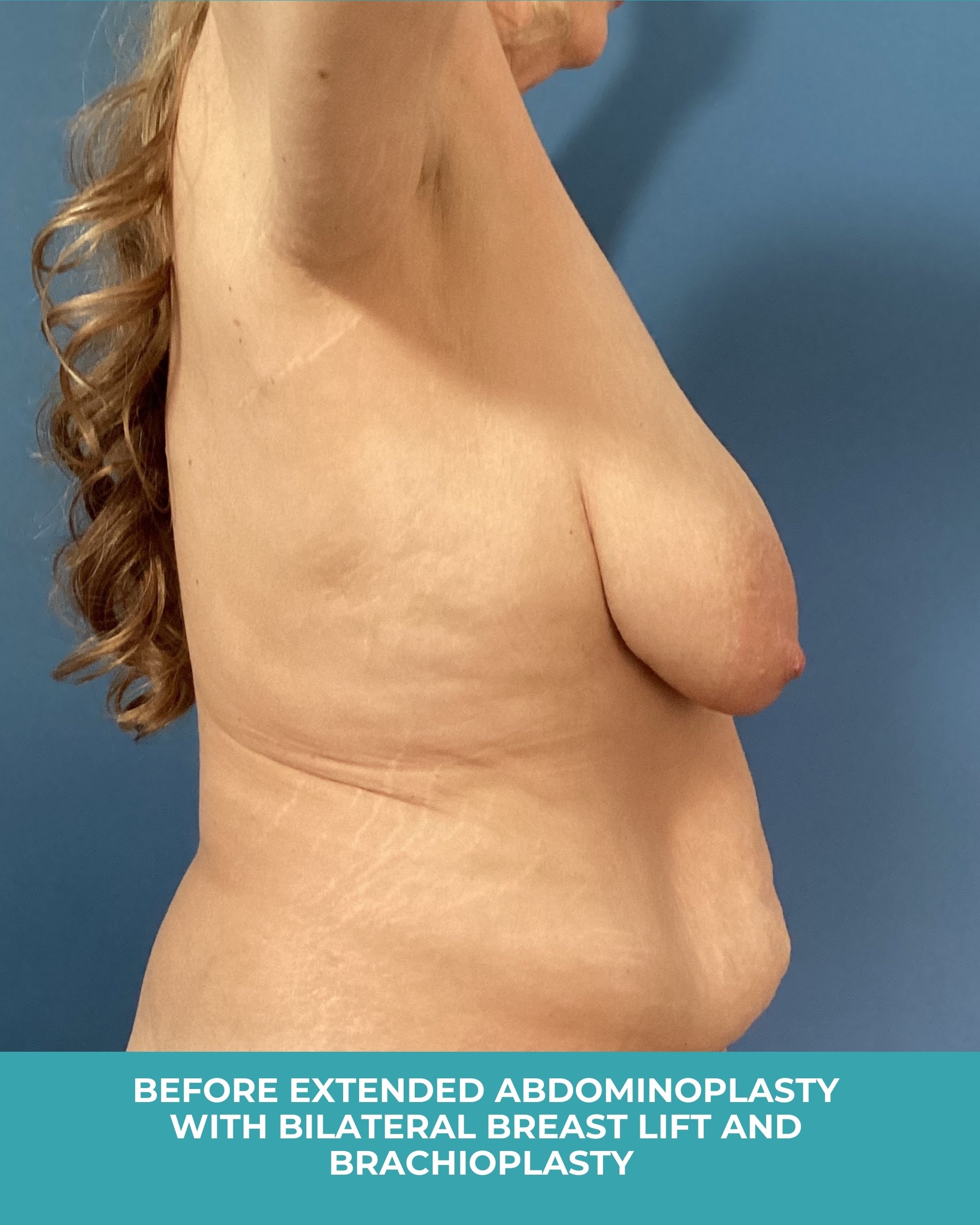B&A extended abdominoplasty with bilateral breast lift and brachioplastyB (5).jpg