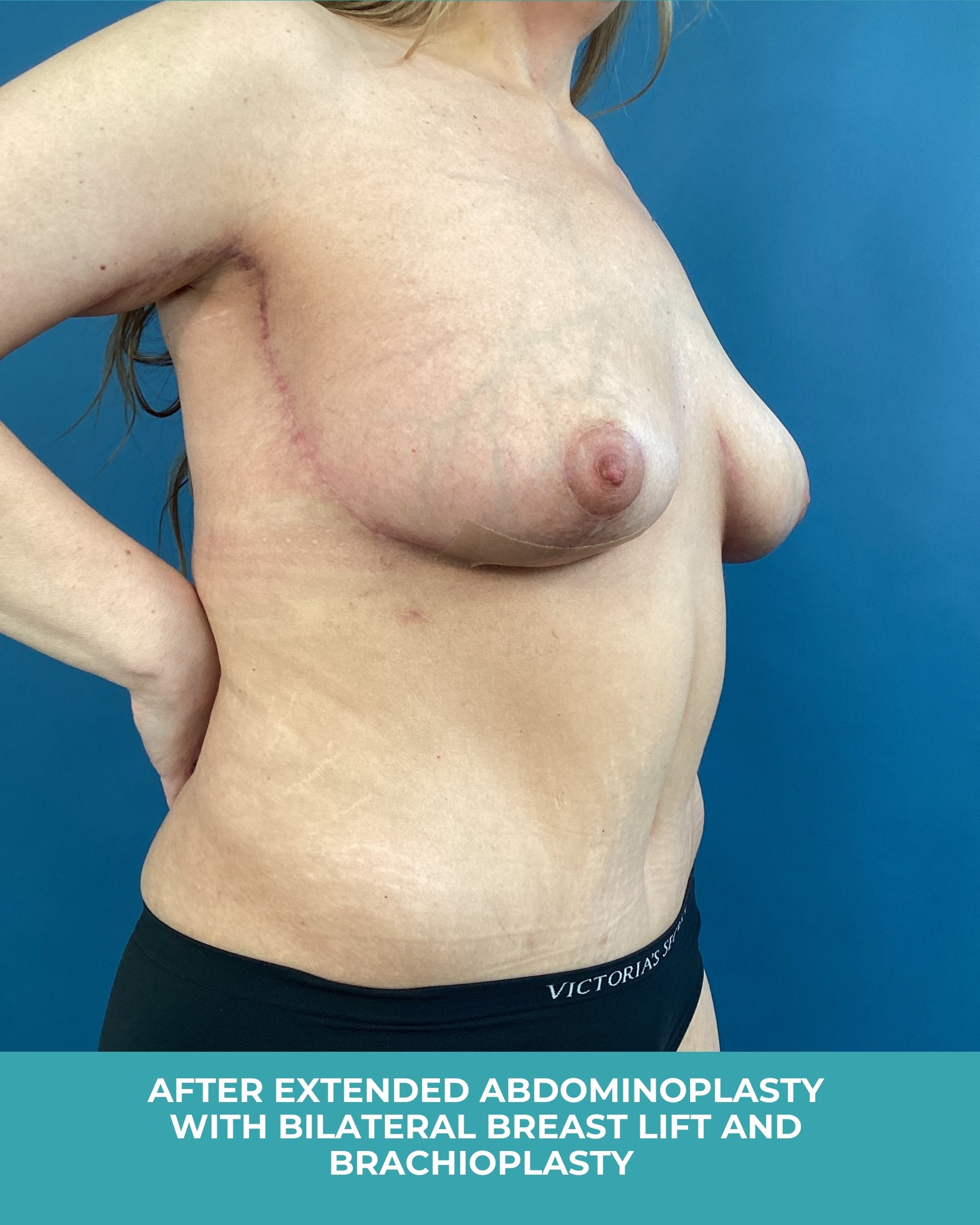 B&A extended abdominoplasty with bilateral breast lift and brachioplastyB (4).jpg