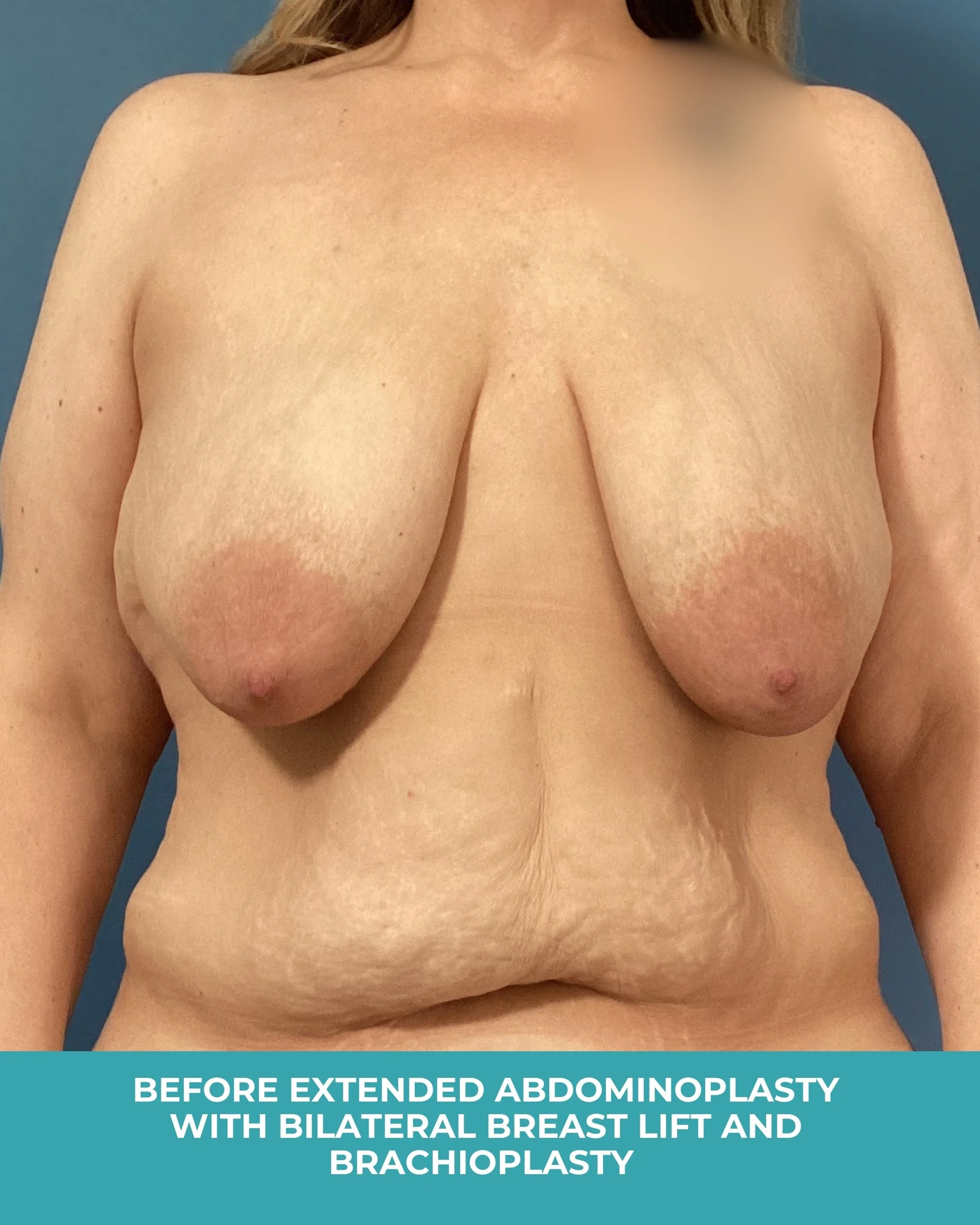 B&A extended abdominoplasty with bilateral breast lift and brachioplastyB.jpg