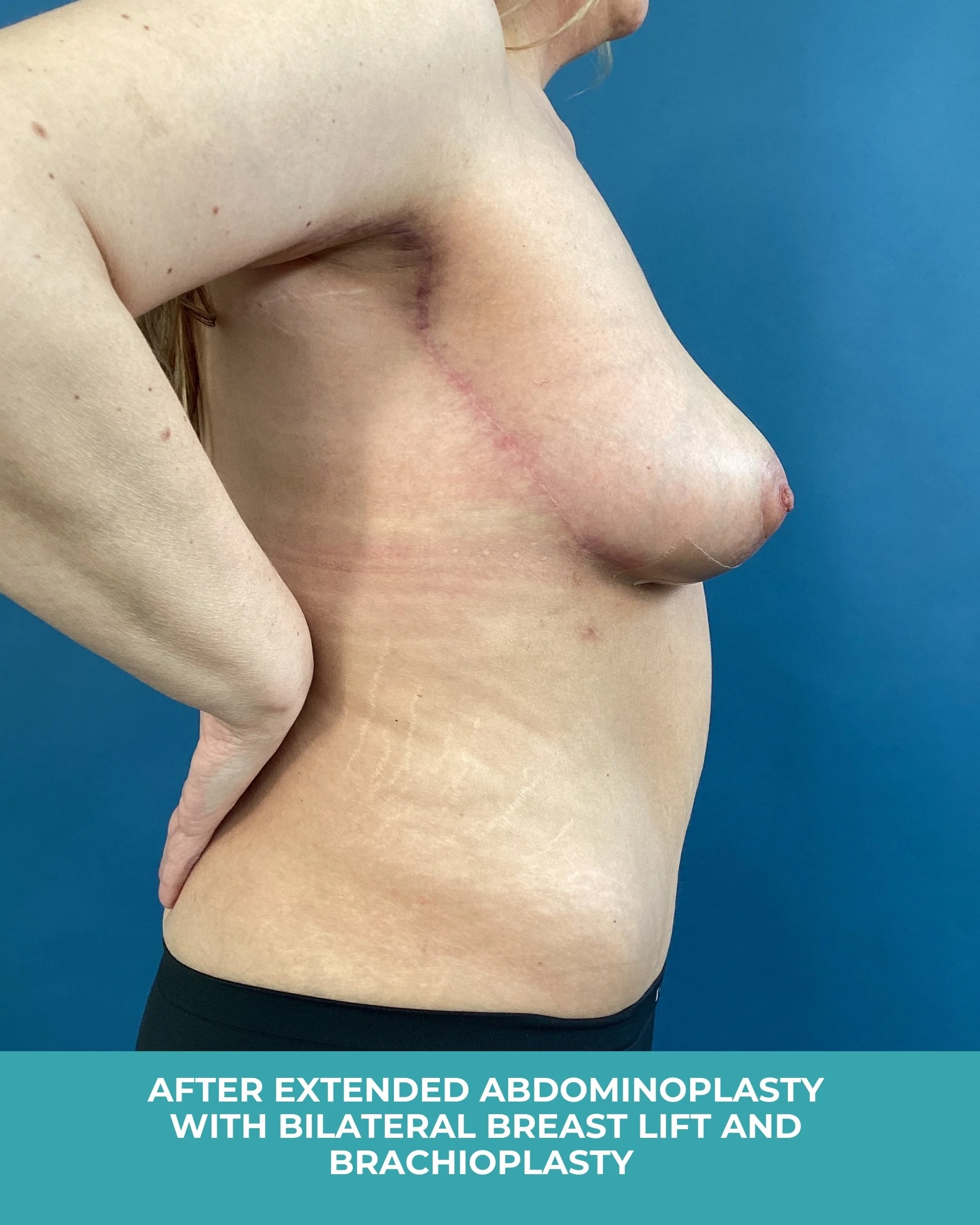 B&A extended abdominoplasty with bilateral breast lift and brachioplastyB (6).jpg