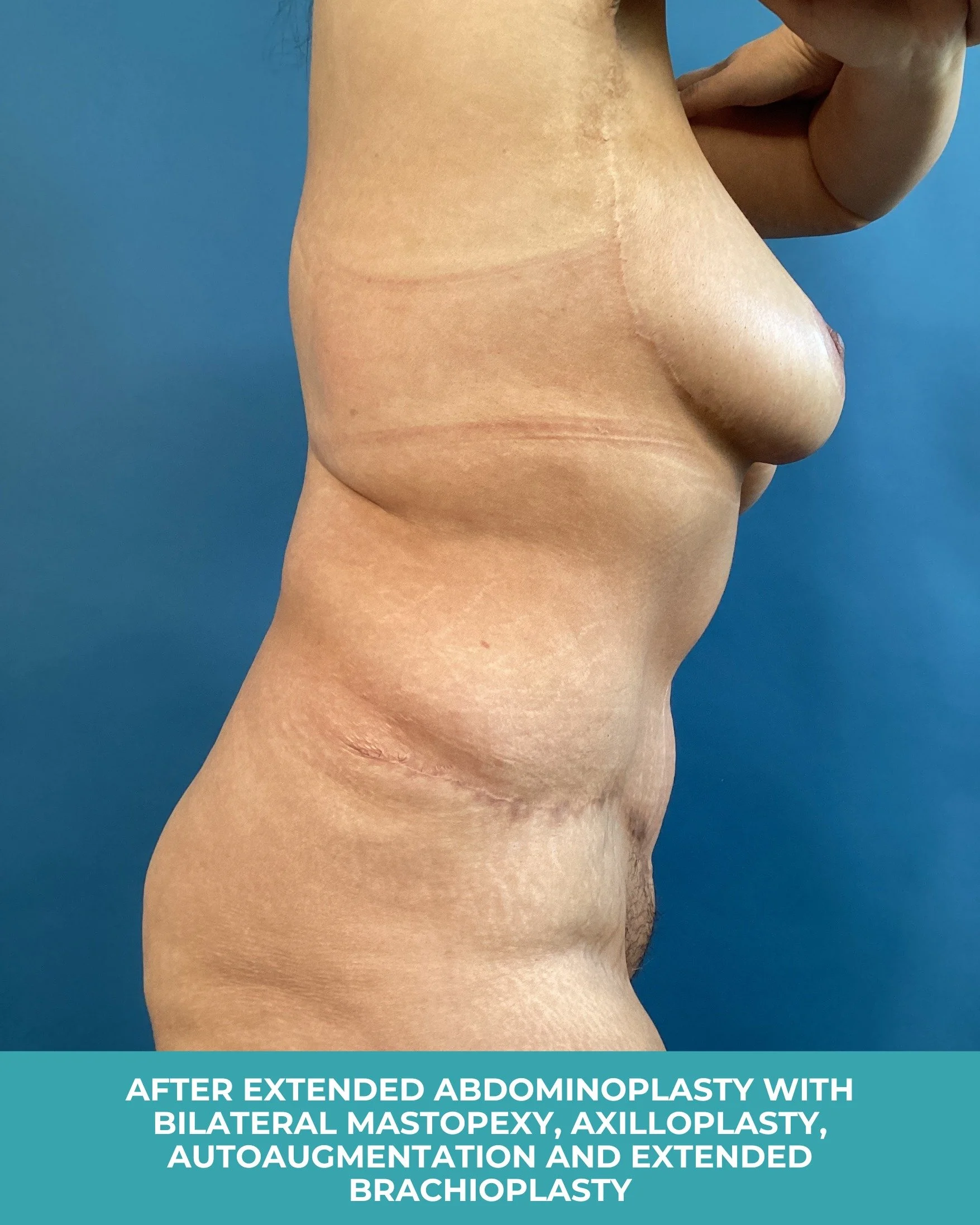 B&A Extended abdominoplasty with Bilateral mastopexy, axilloplasty, autoaugmentation and extended brachioplasty (6).jpg