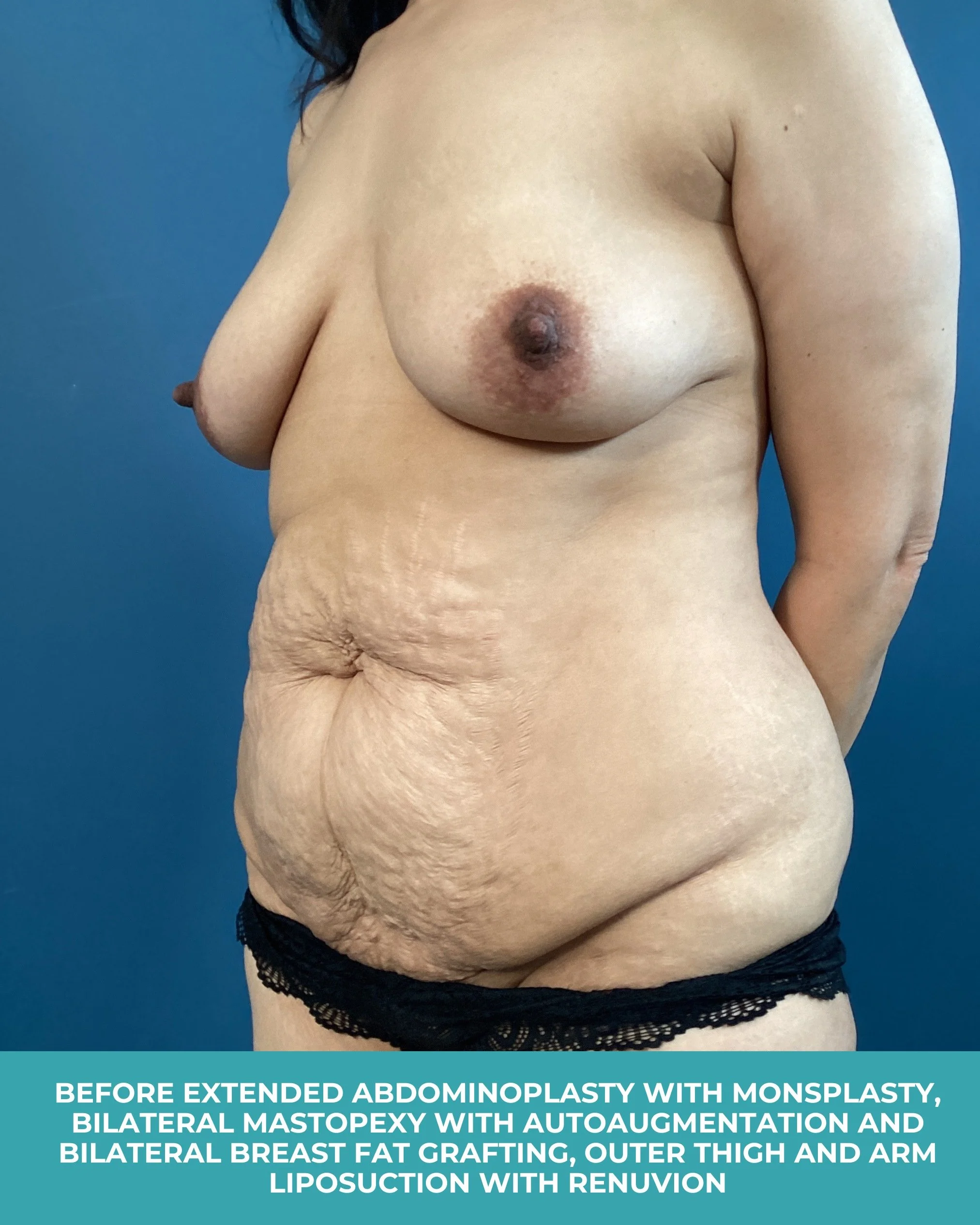 B&A extended abdominoplasty with monsplasty, bilateral mastopexy with autoaugmentation with bilateral breast fat grafting, and outer thigh and arm liposuction with Renuvion (3).jpg