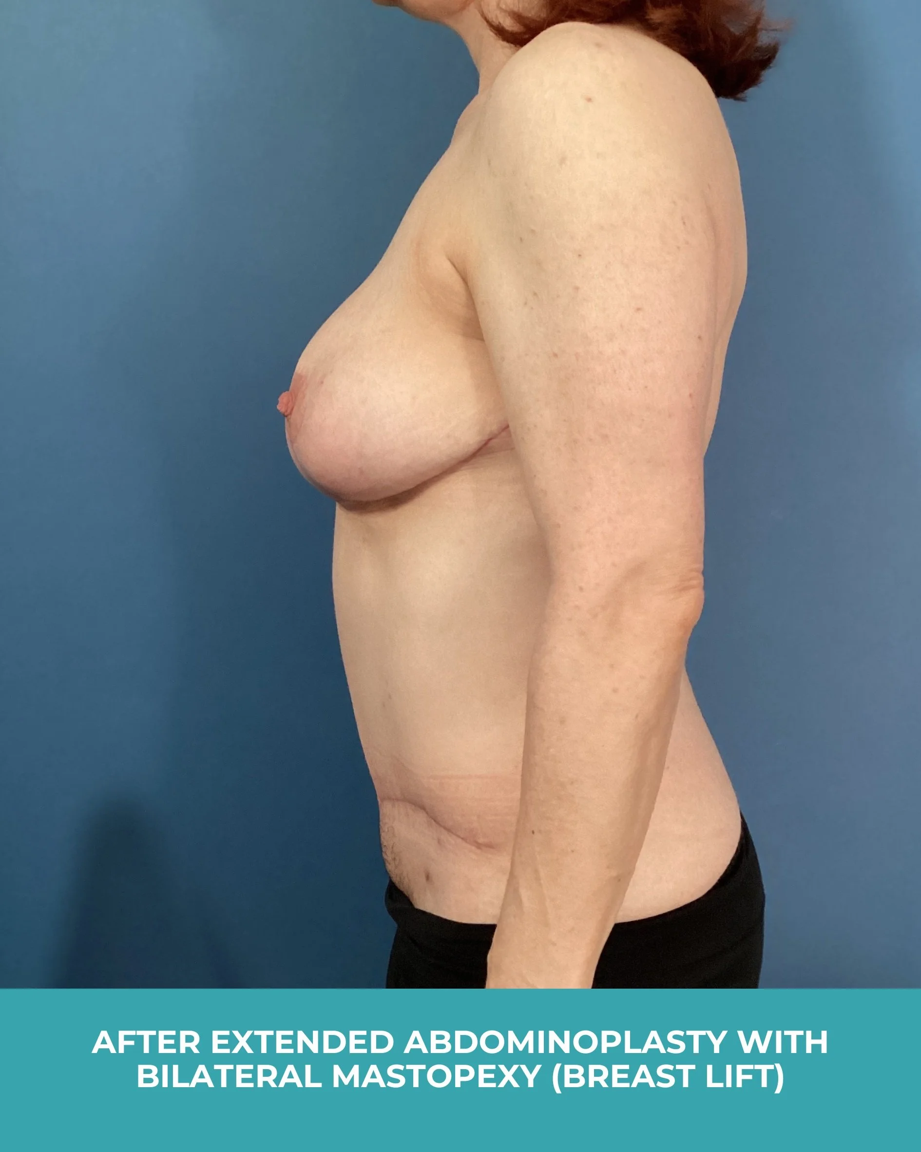 B&A extended abdominoplasty with bilateral mastopexy (breast lift) (6).jpg