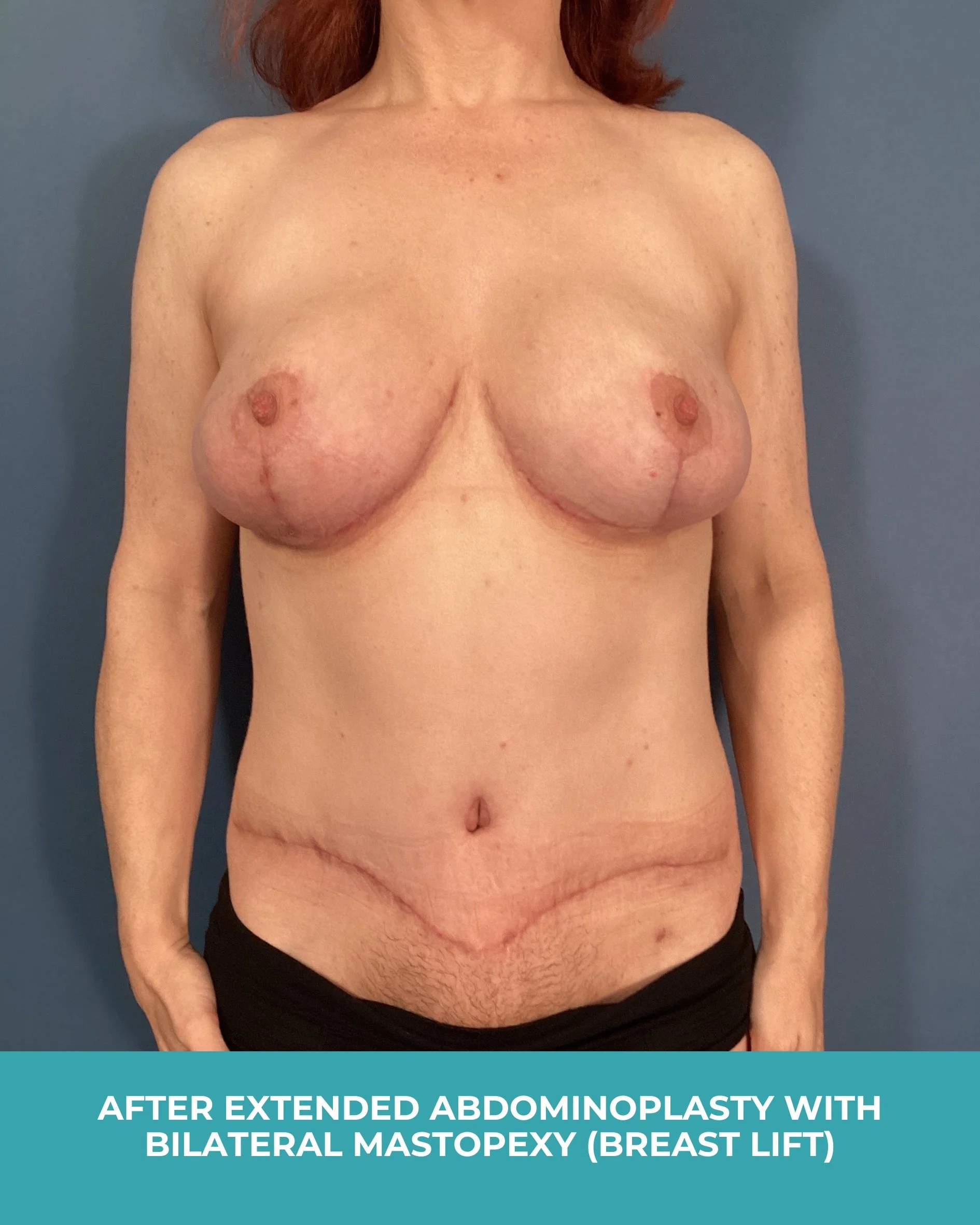 B&A extended abdominoplasty with bilateral mastopexy (breast lift) (2).jpg