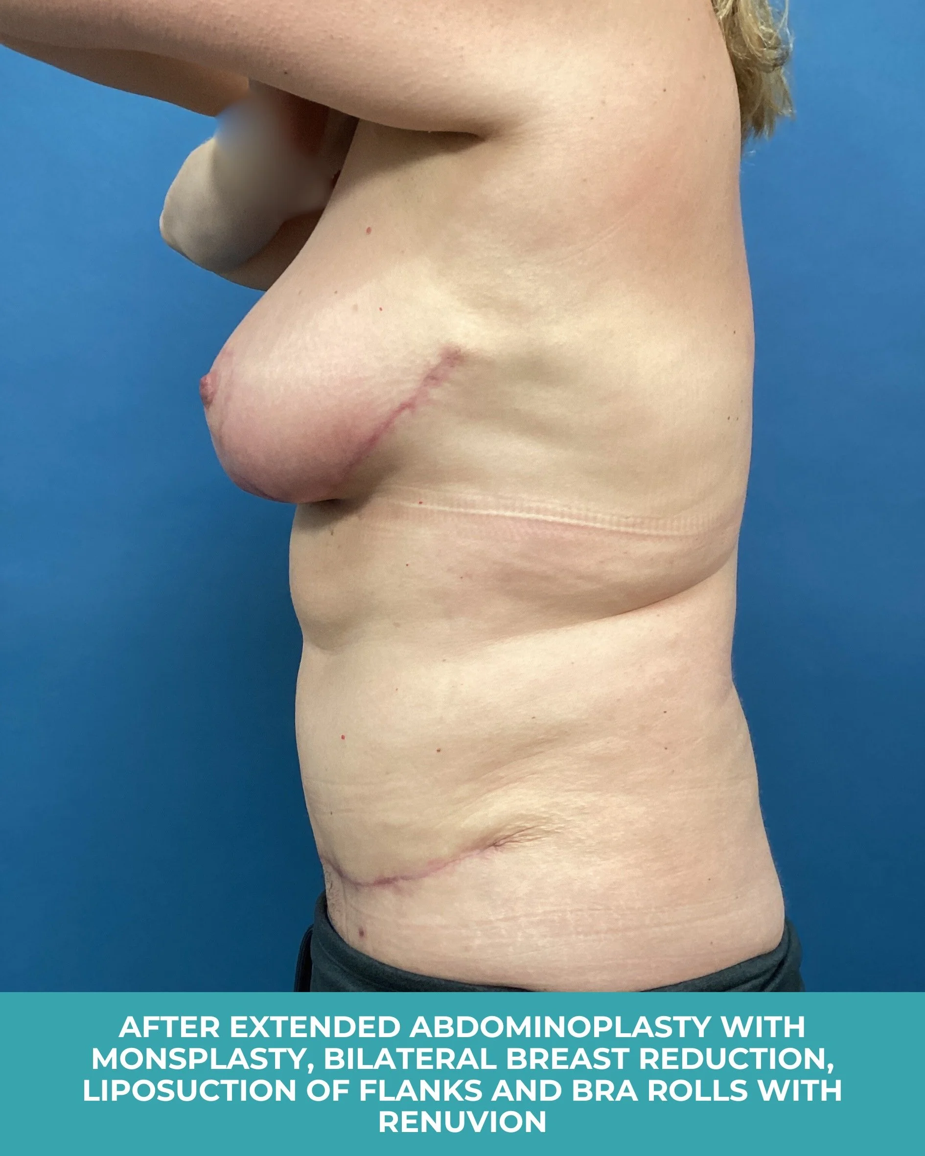 B&A extended abdominoplasty with bilateral mastopexy (breast lift).jpg