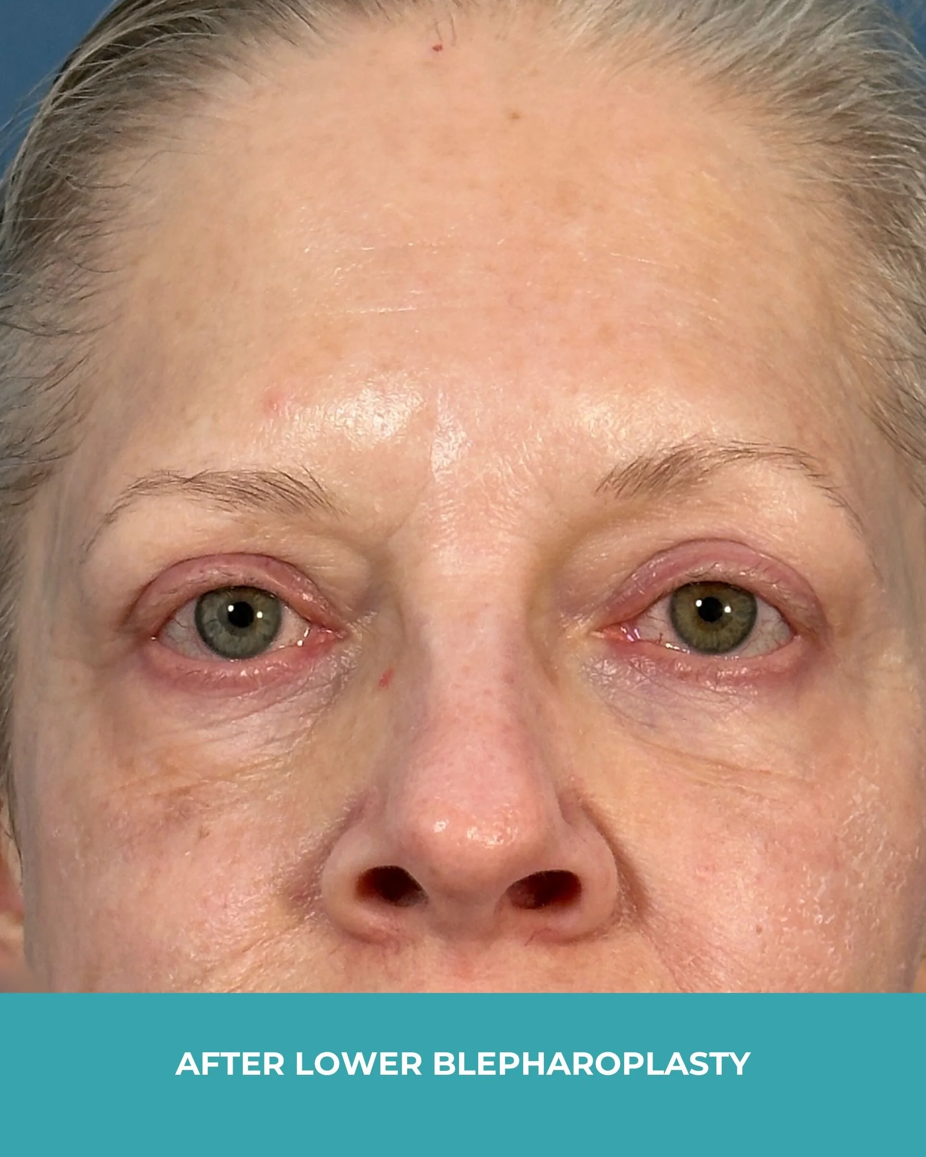 B&A lower blepharoplasty (2).jpg