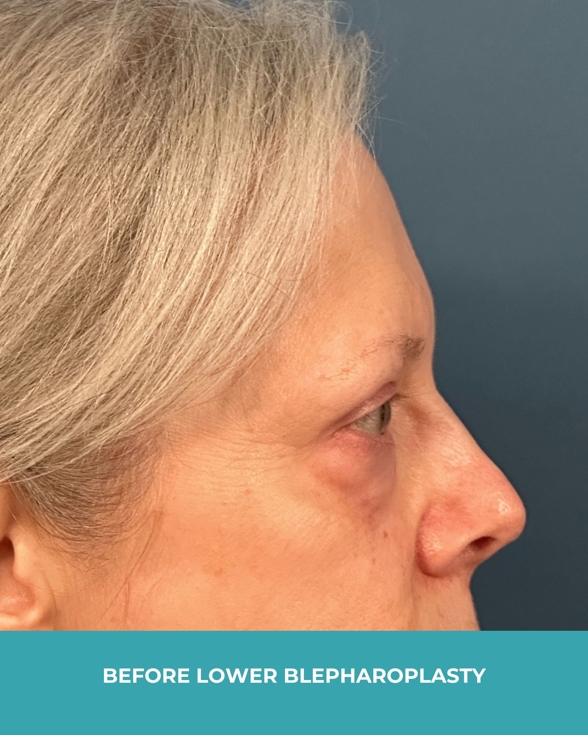 B&A lower blepharoplasty (5).jpg