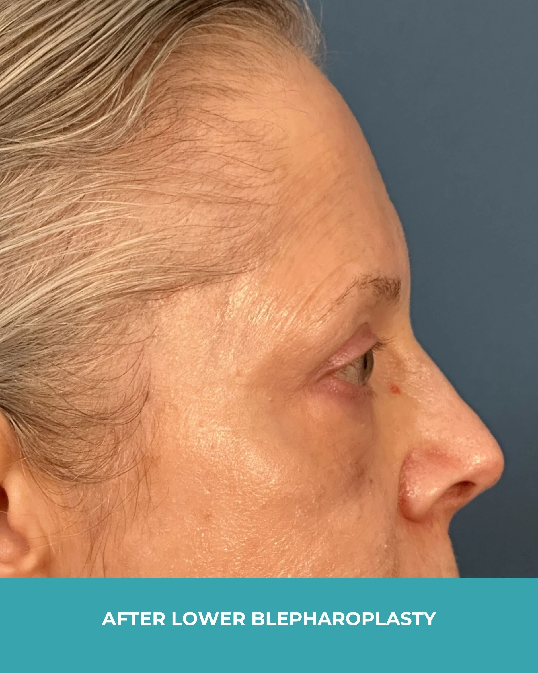 B&A lower blepharoplasty (6).jpg
