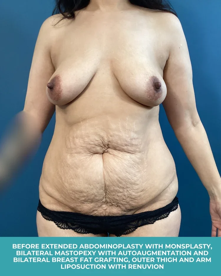 B&A+extended+abdominoplasty+with+monsplasty,+bilateral+mastopexy+with+autoaugmentation+with+bilateral+breast+fat+grafting,+and+outer+thigh+and+arm+liposuction+with+Renuvion.webp