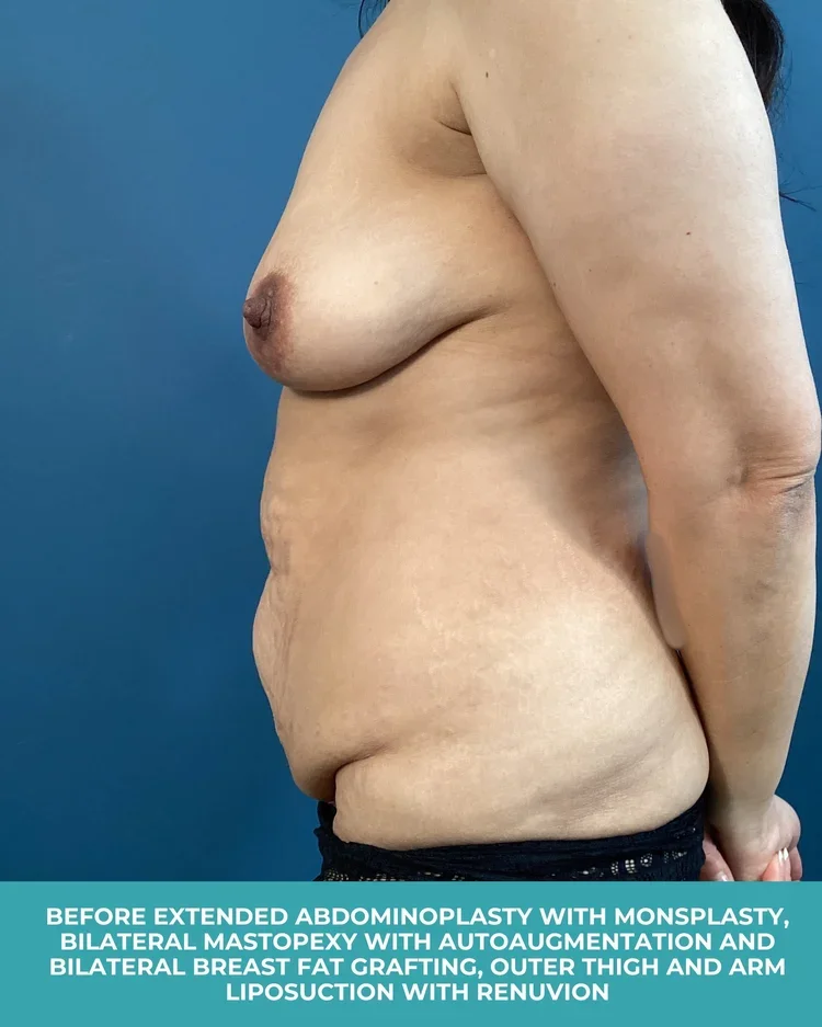 B&A+extended+abdominoplasty+with+monsplasty,+bilateral+mastopexy+with+autoaugmentation+with+bilateral+breast+fat+grafting,+and+outer+thigh+and+arm+liposuction+with+Renuvion+(5).webp