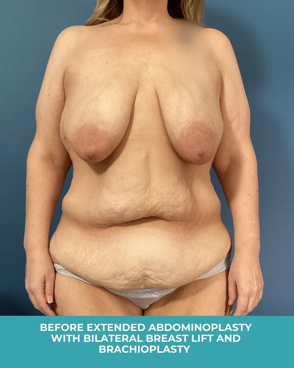 B&A+extended+abdominoplasty+with+bilateral+breast+lift+and+brachioplasty (1).webp