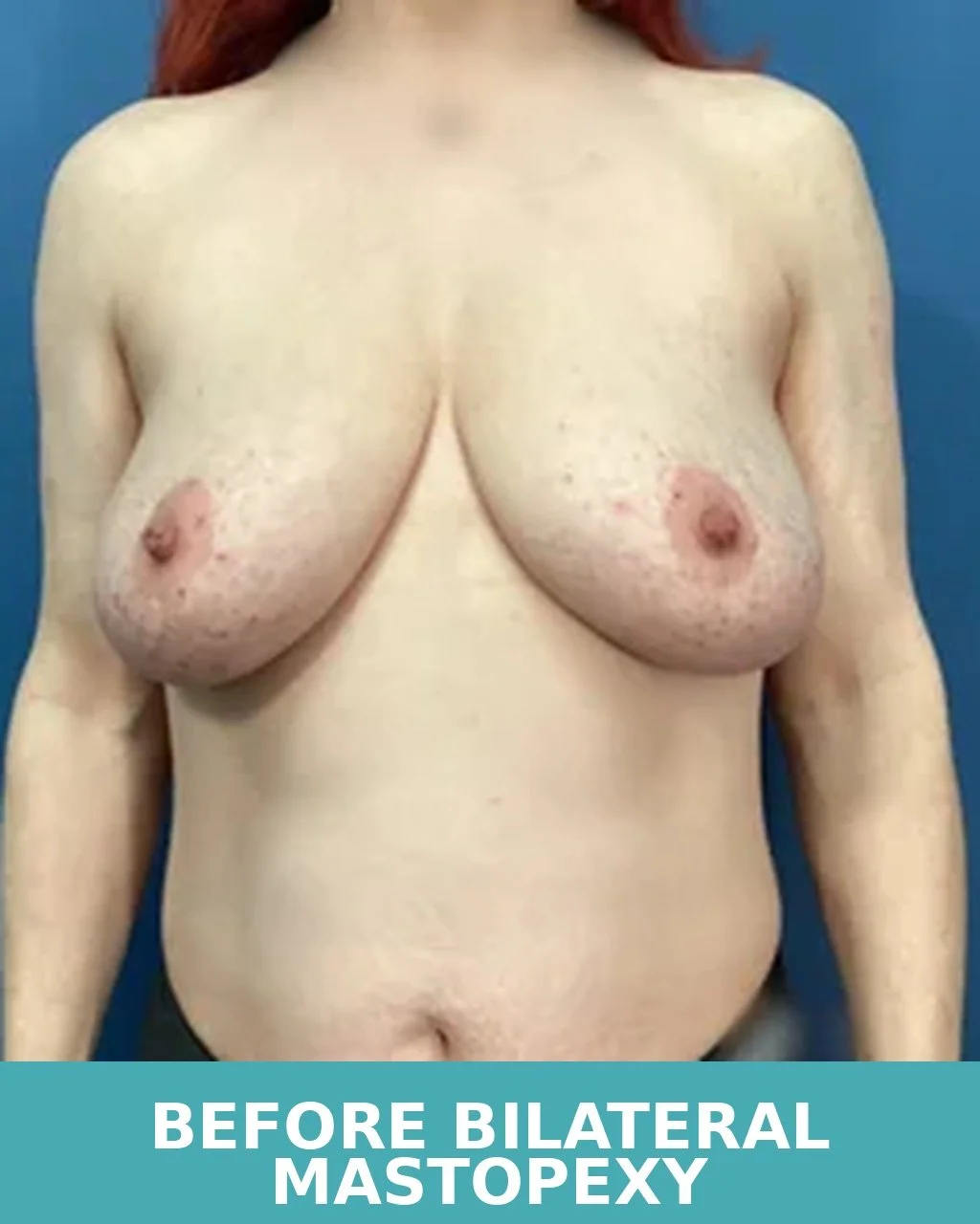 mastopexy2_before_front.jpg