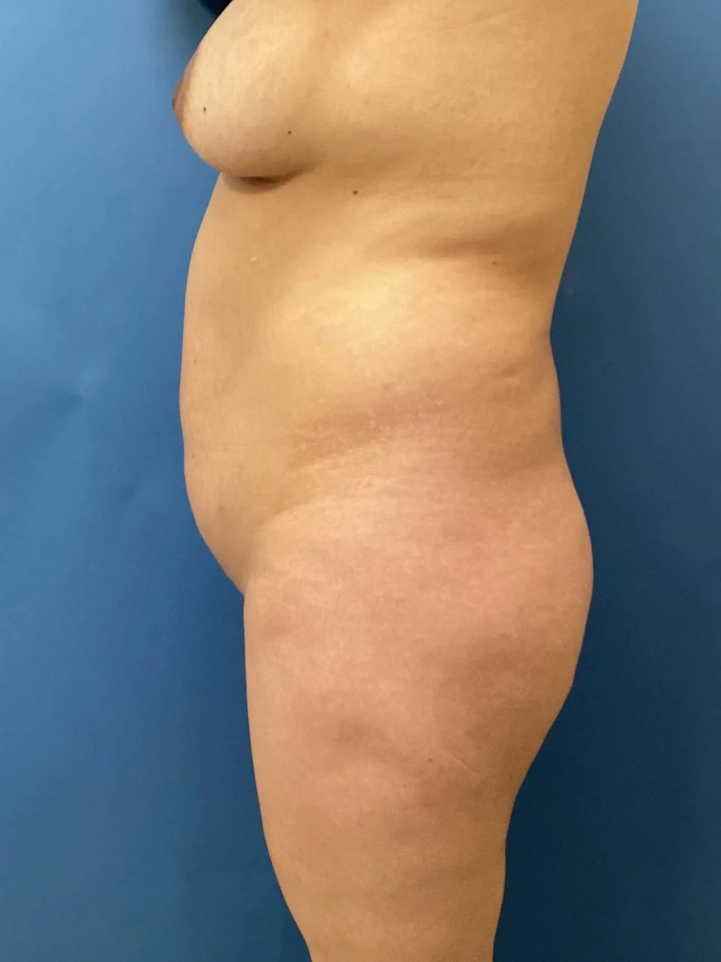 gluteus-lateral-right-11.03.2025-96169458.jpeg