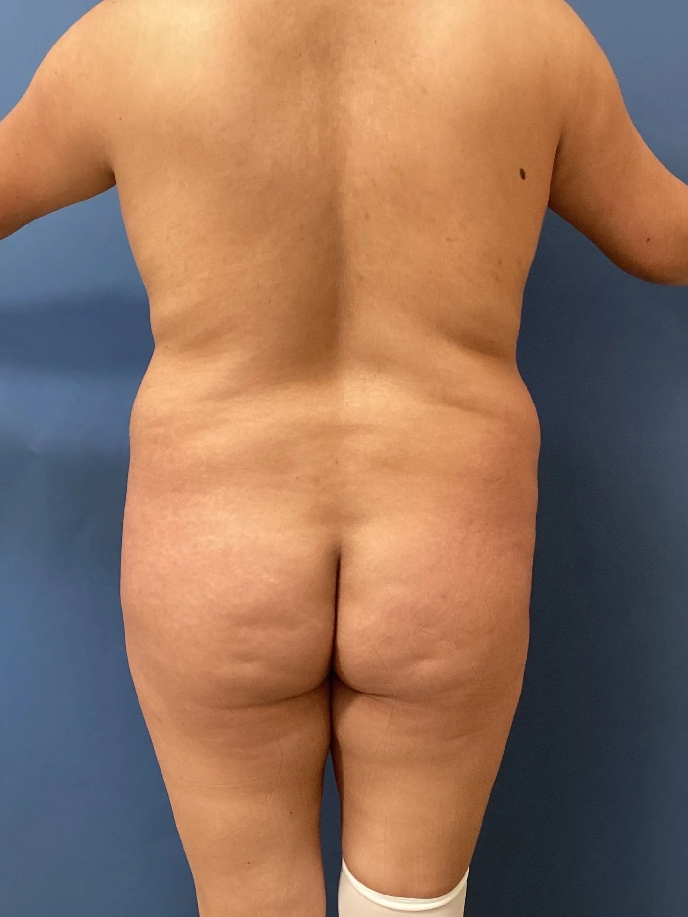 gluteus-posterior-11.03.2025-96169391.jpeg