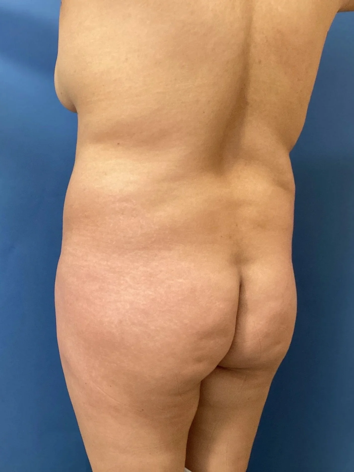 gluteus-posterior-oblique-right-11.03.2025-96169428.jpeg