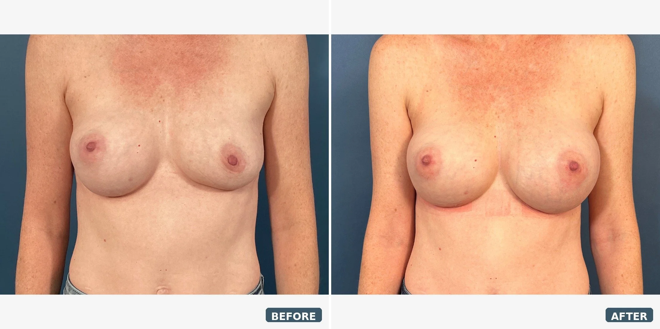 Bilateral Capsulectomy and Implant Exchange 