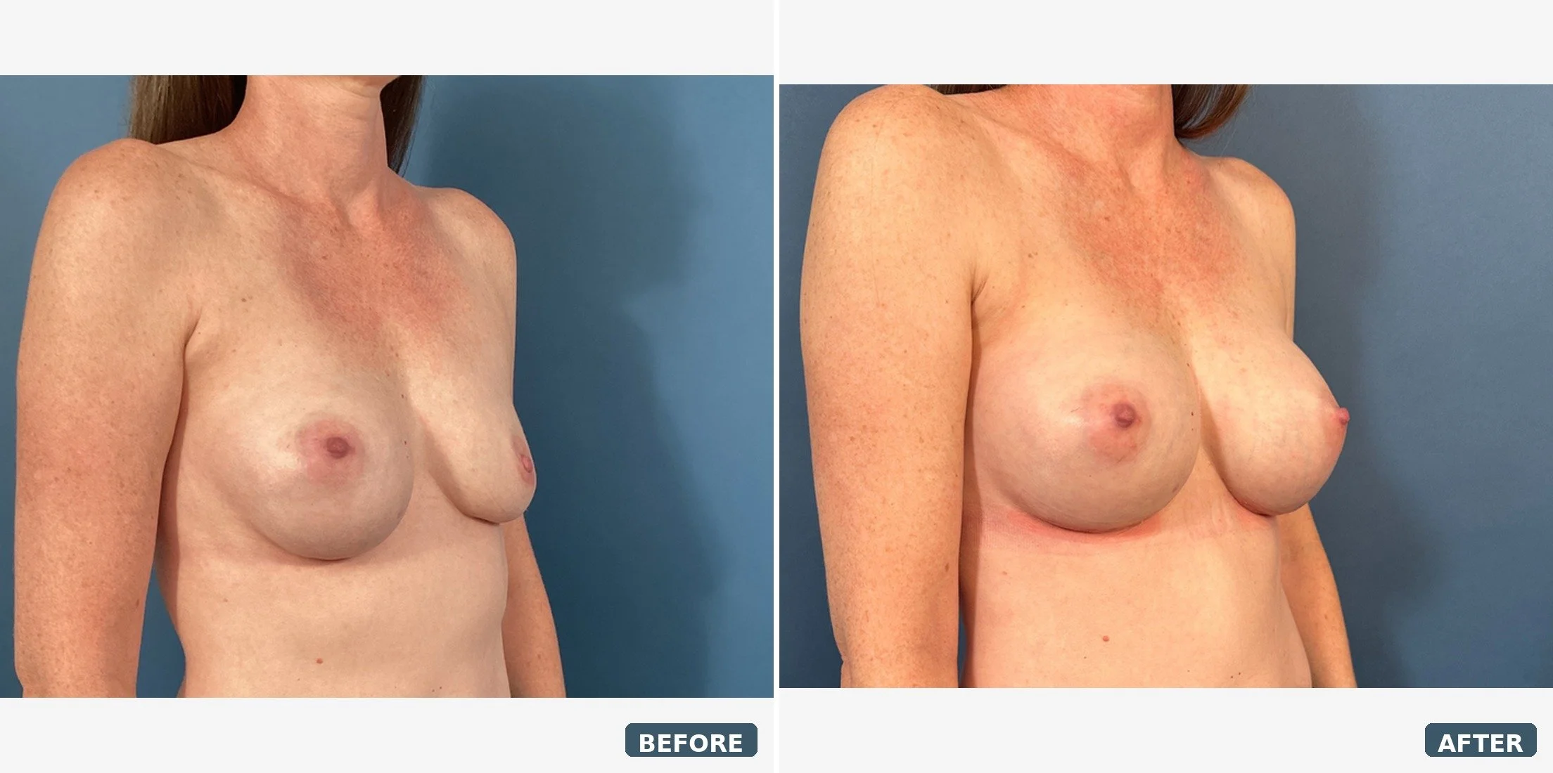 Bilateral Capsulectomy and Implant Exchange 