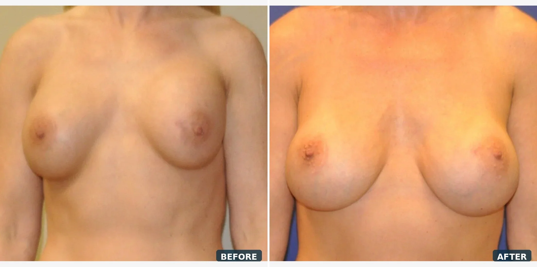 breast implant removal, capsulectomy, and implant replacement