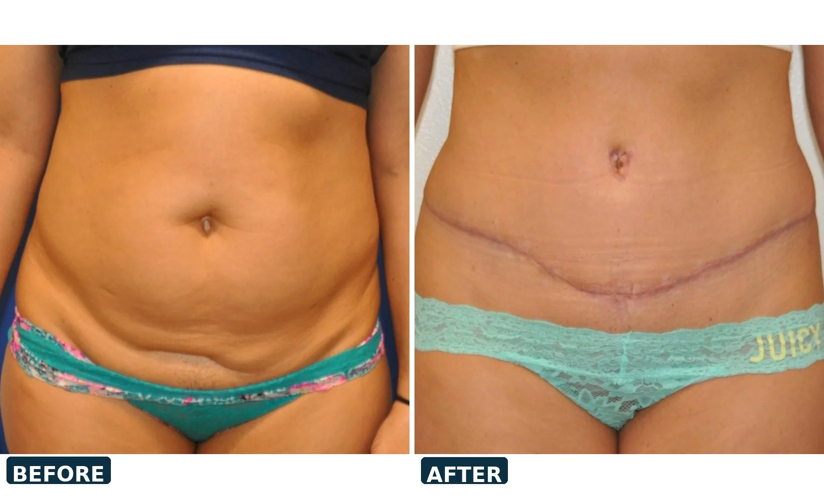 pearl-tummy-tuck-case-06-front-before-after.jpg