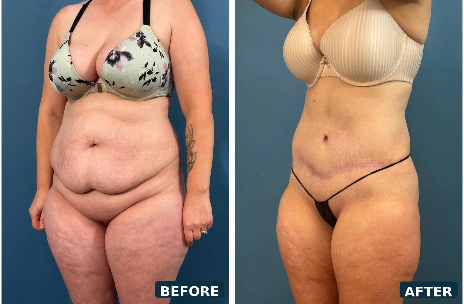 pearl-extended-abdominoplasty-three-quarter-b-before-after.jpg
