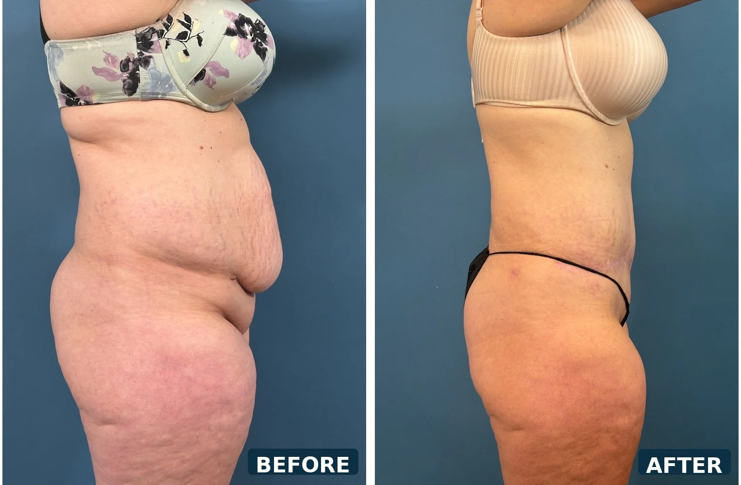 pearl-extended-abdominoplasty-profile-a-before-after.jpg