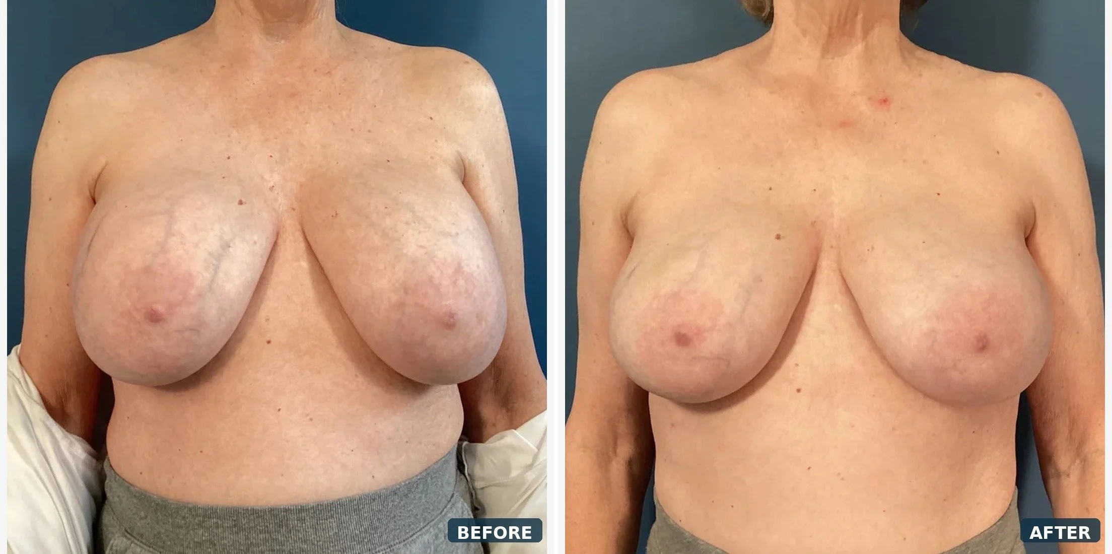 Bilateral Capsuiectomy & Implant Removal