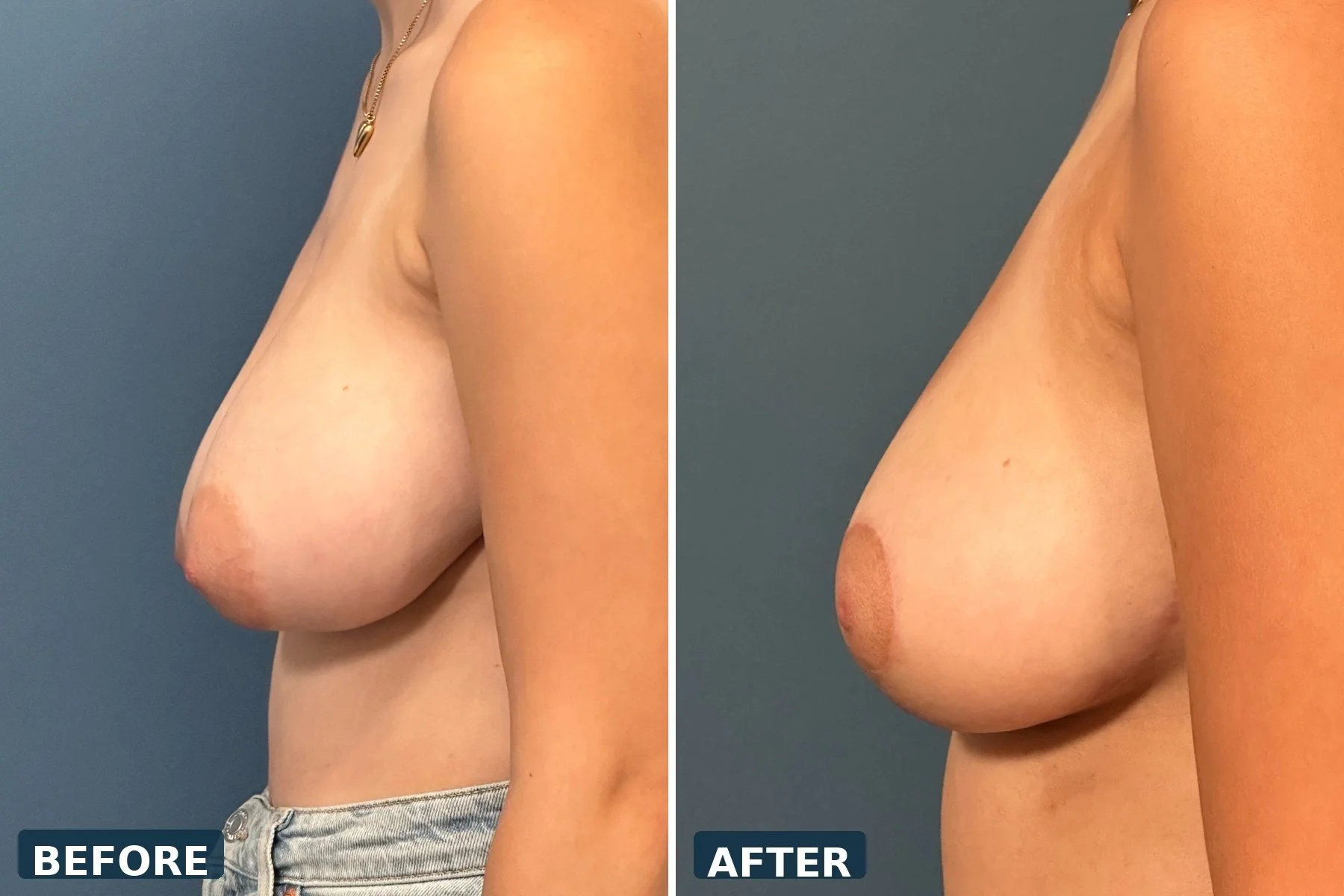 pearl-breast-reduction-case-09-profile-right-before-after.jpg