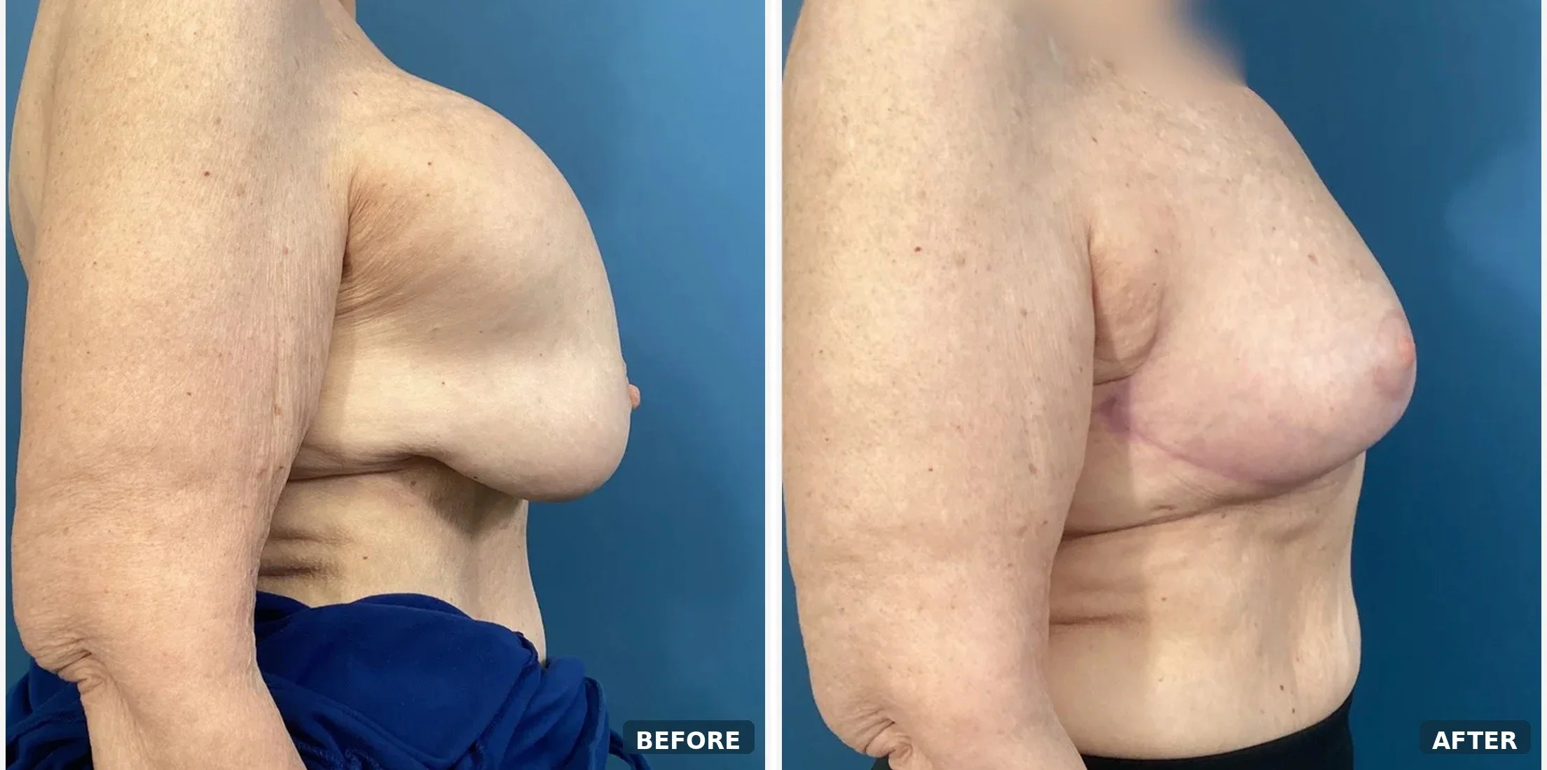 Bilateral Capsuiectomy & Implant Removal & Mastopexy