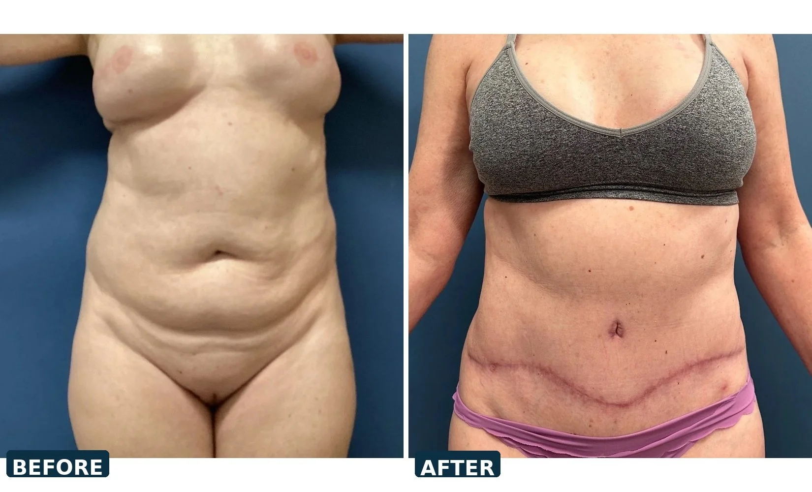 pearl-tummy-tuck-case-07-front-before-after.jpg