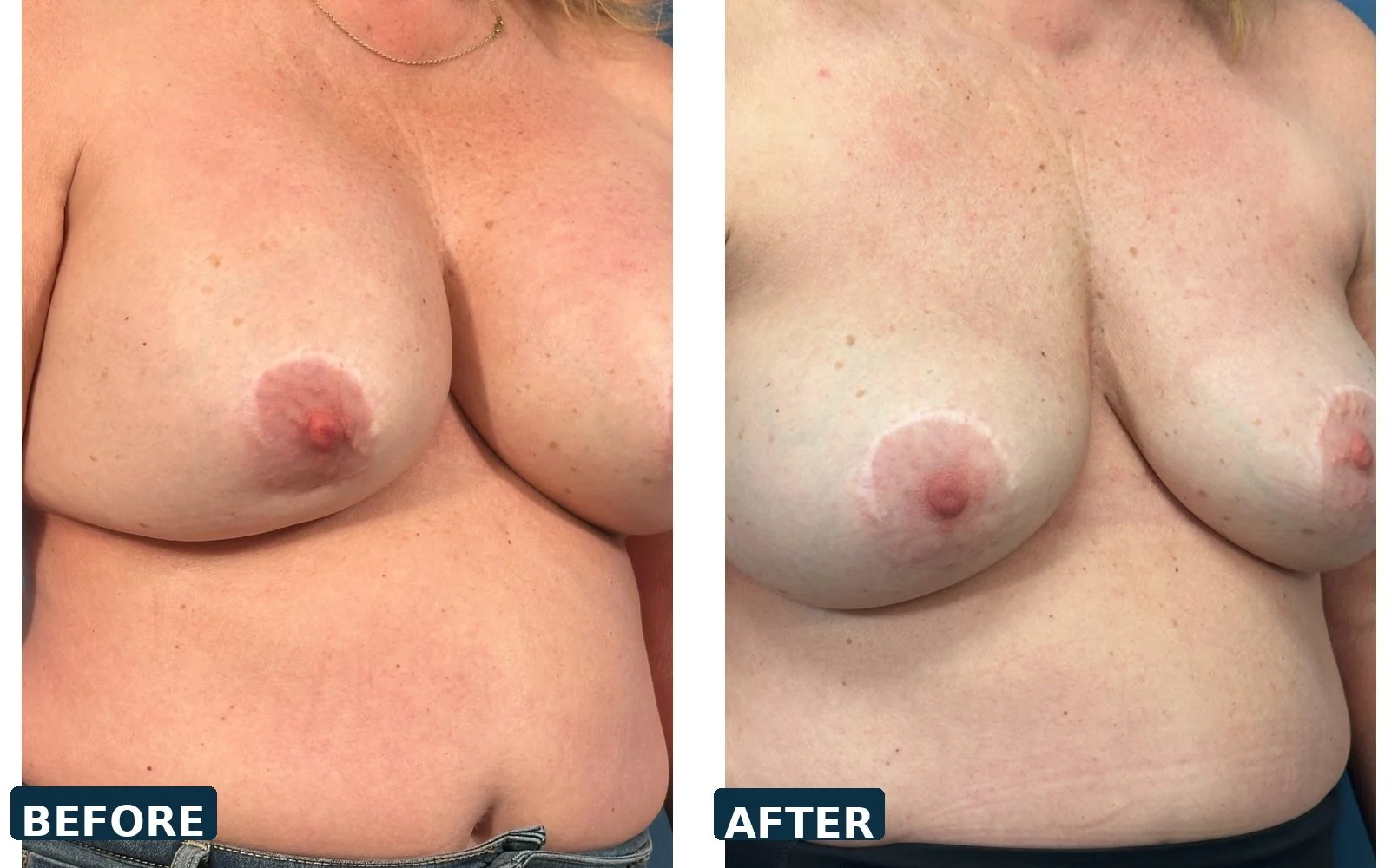 Bilateral Capsulectomy and Implant Exchange 