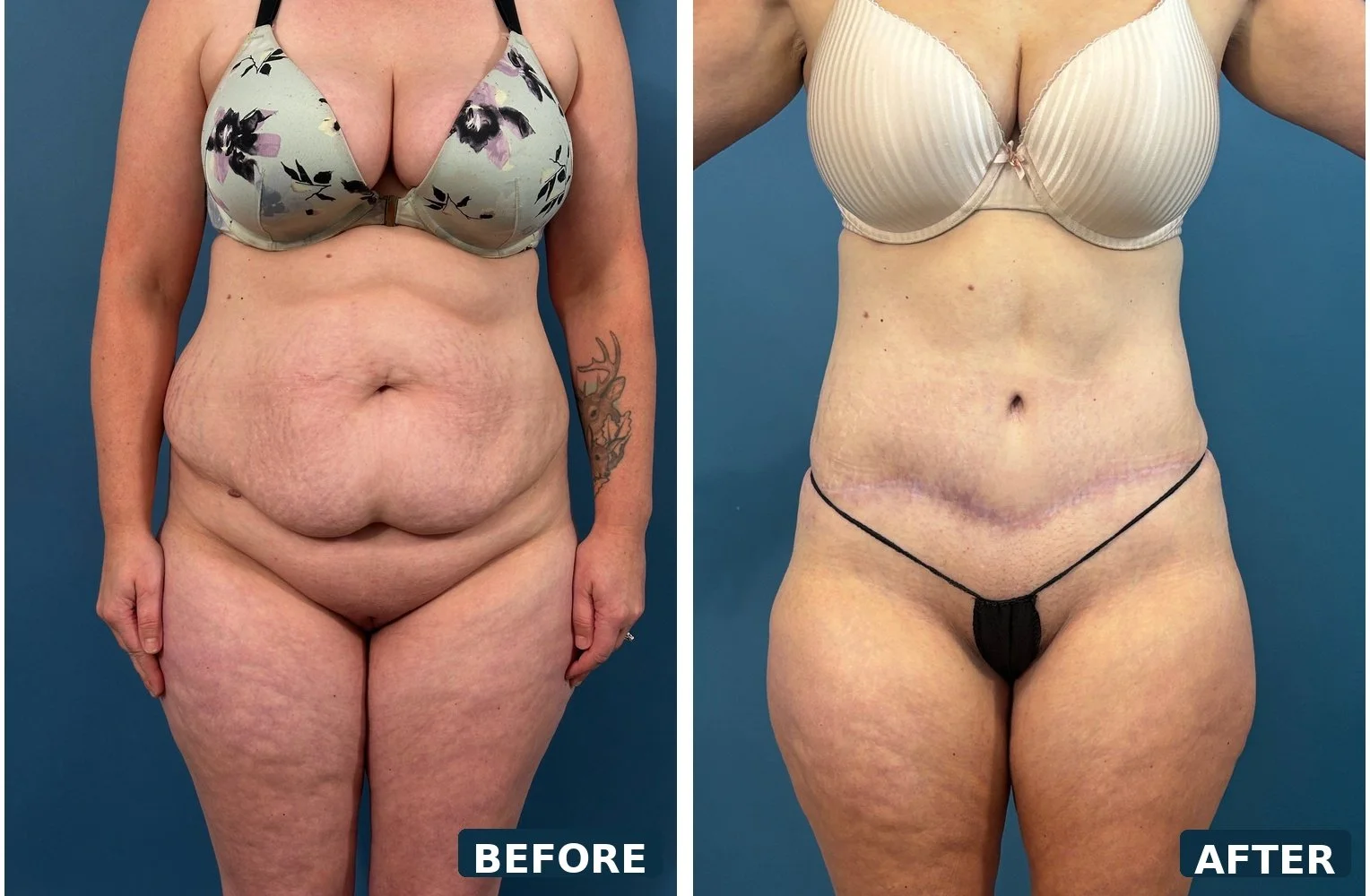 Tummy Tuck