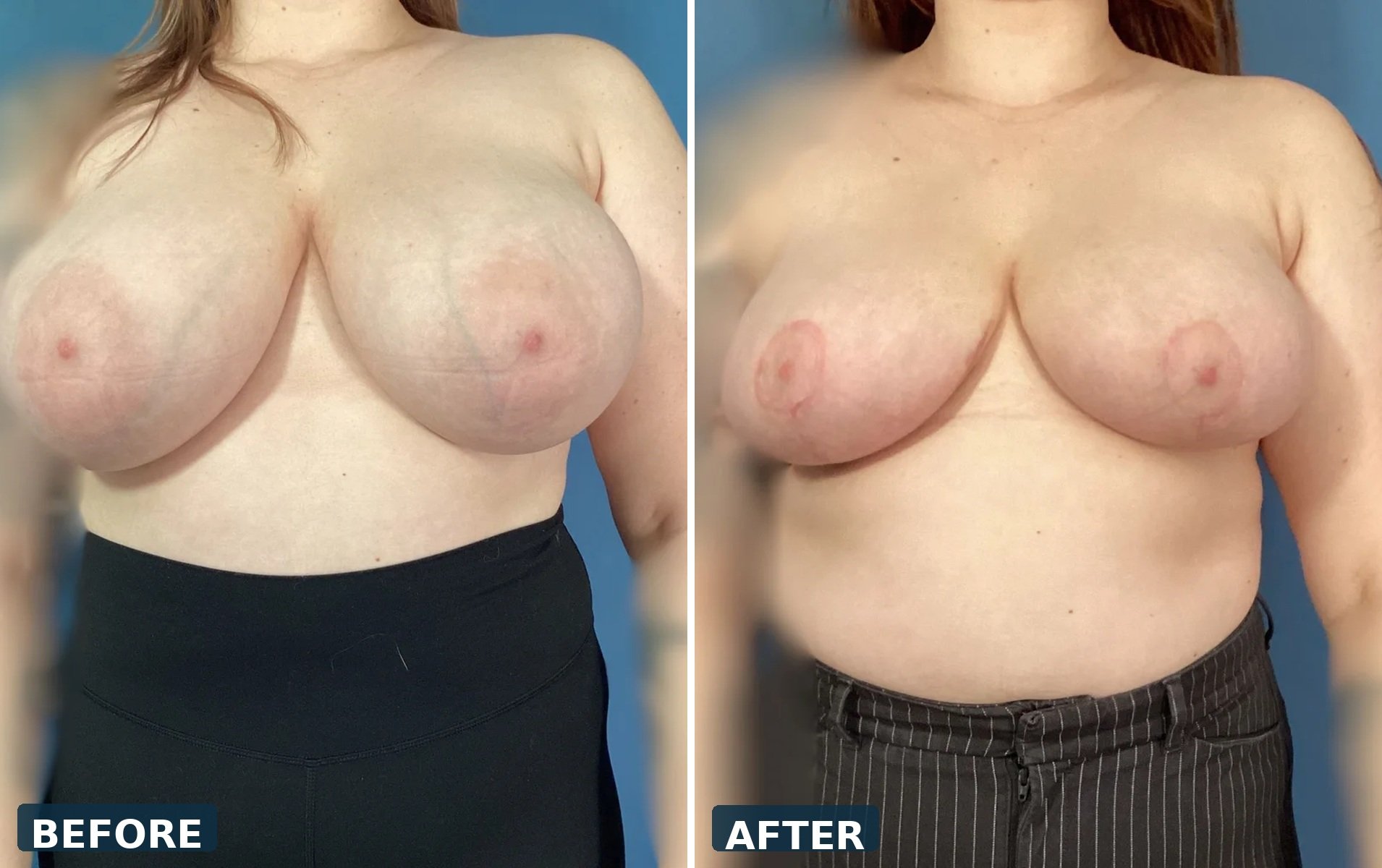 pearl-breast-reduction-case-02-front-before-after.jpg