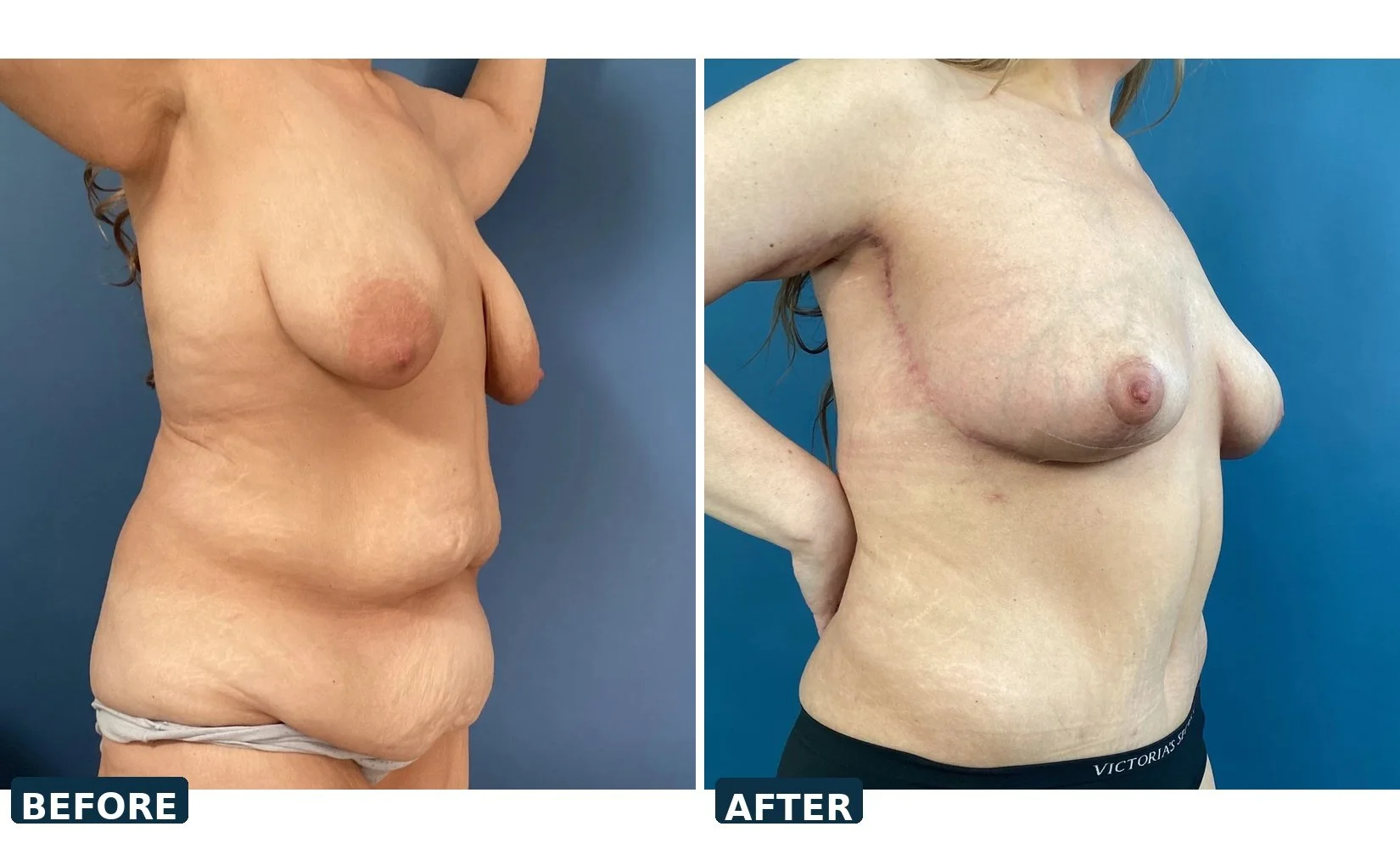pearl-tummy-tuck-case-02-three-quarter-before-after.jpg
