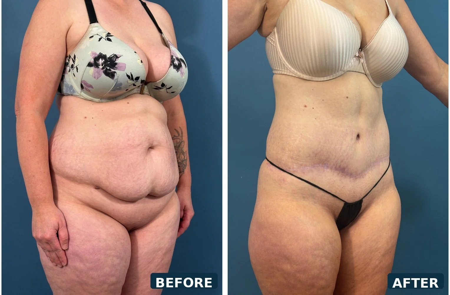 pearl-extended-abdominoplasty-three-quarter-a-before-after.jpg