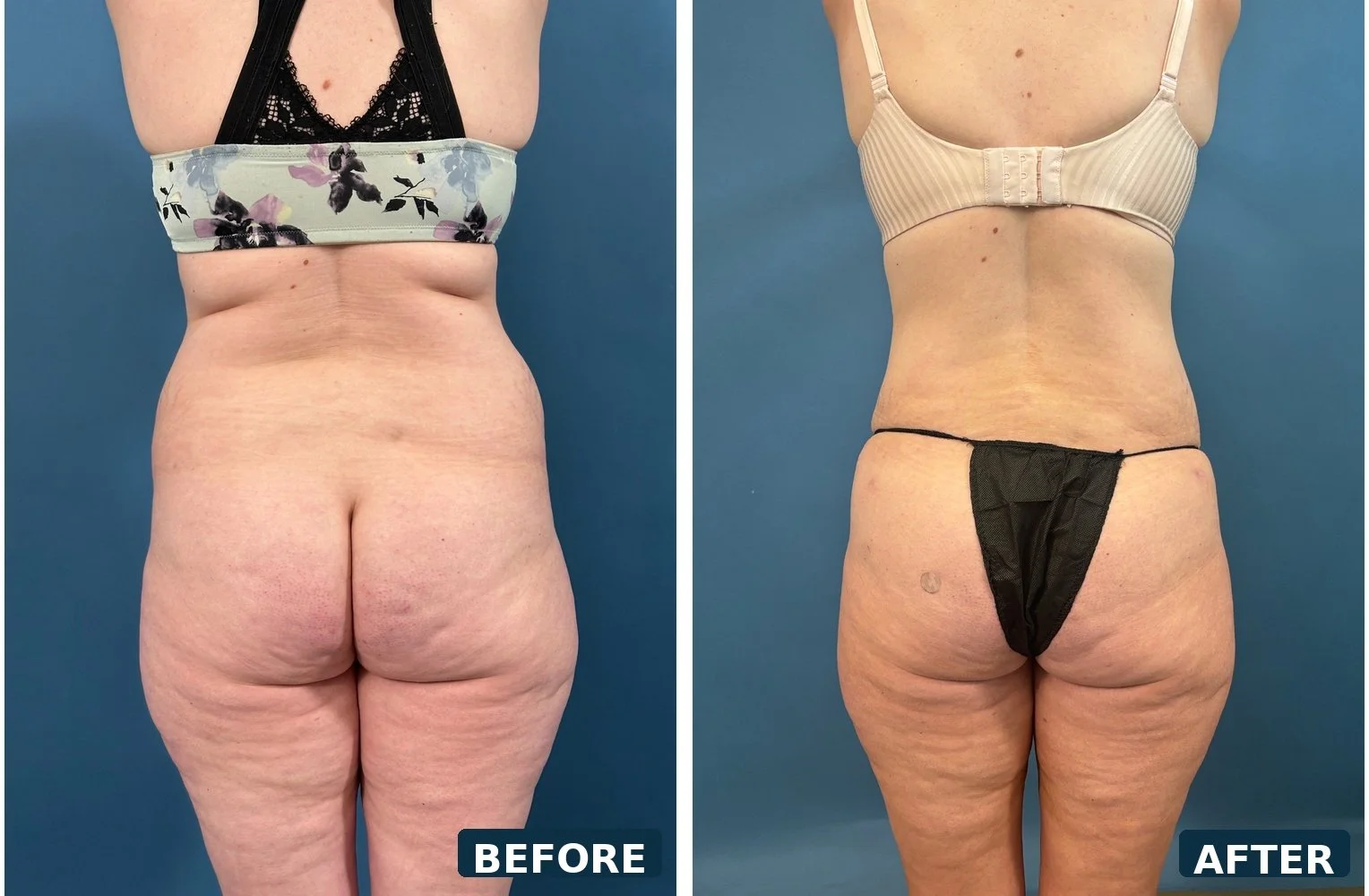 pearl-extended-abdominoplasty-back-before-after.jpg