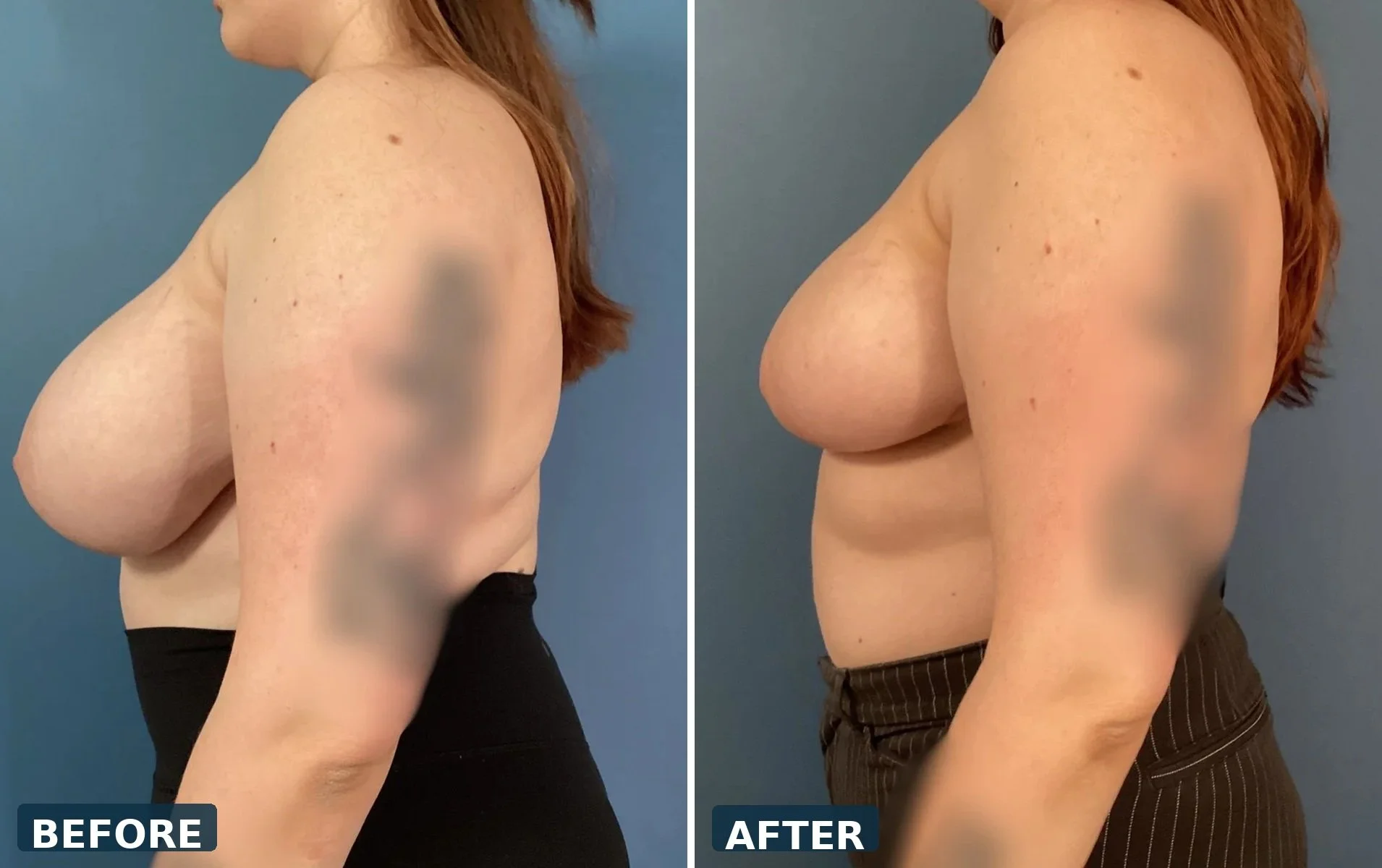 pearl-breast-reduction-case-02-profile-before-after.jpg