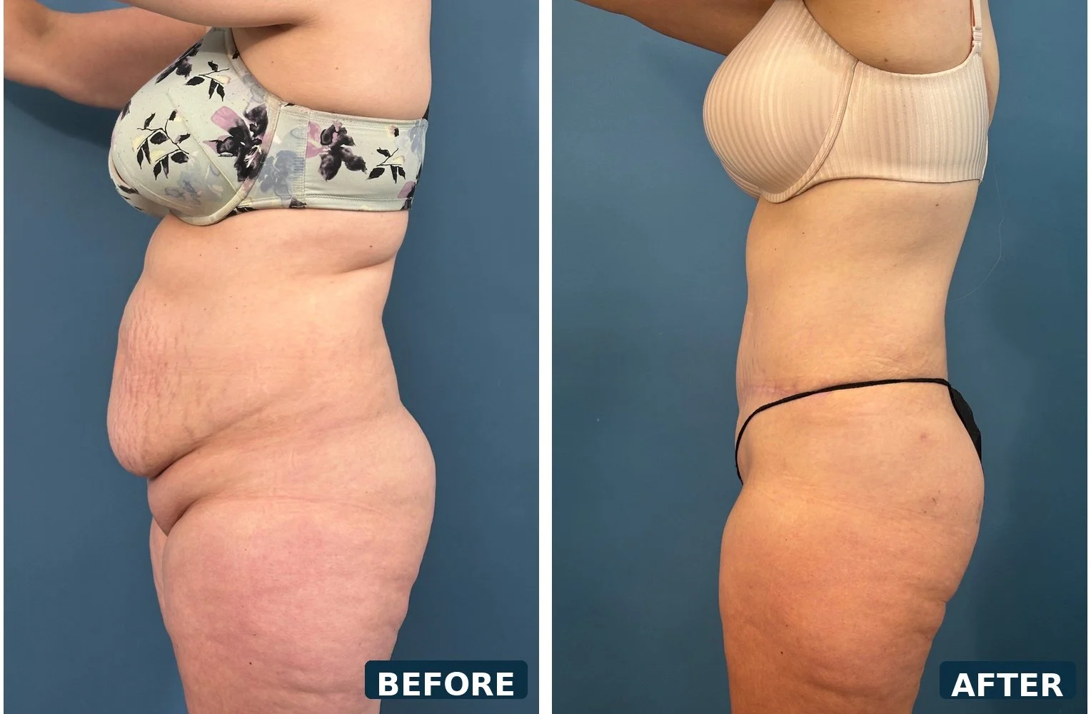 pearl-extended-abdominoplasty-profile-b-before-after.jpg